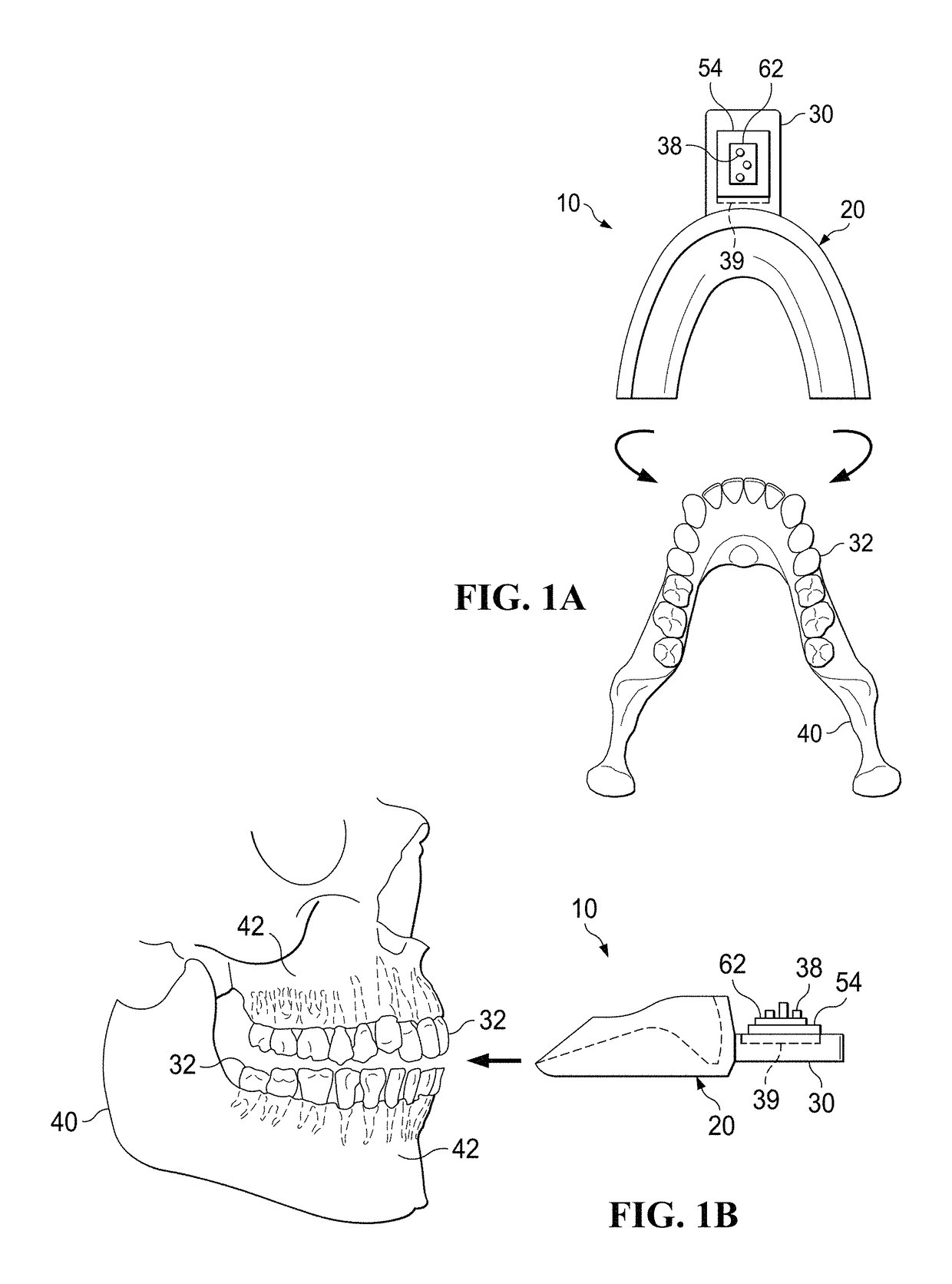 Orthodontic accelerator