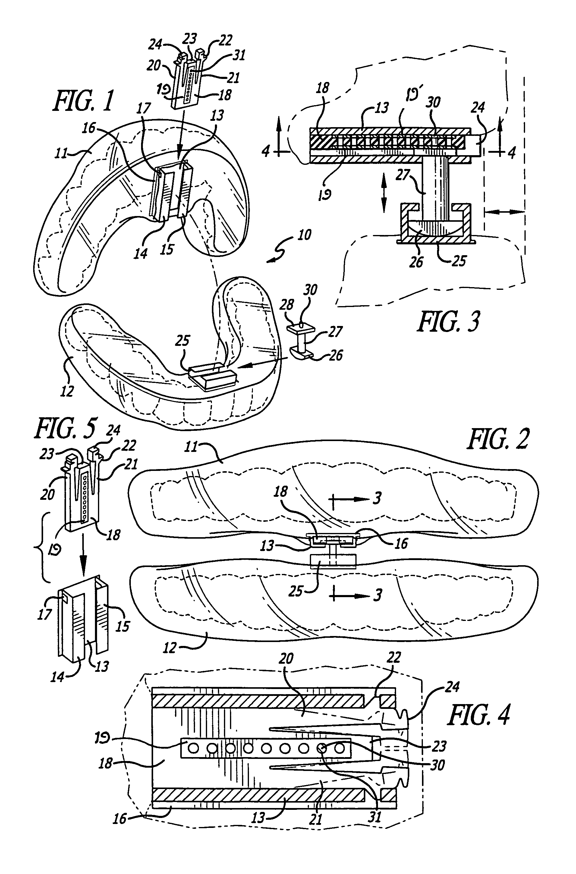 Fixed therapeutic oral appliance