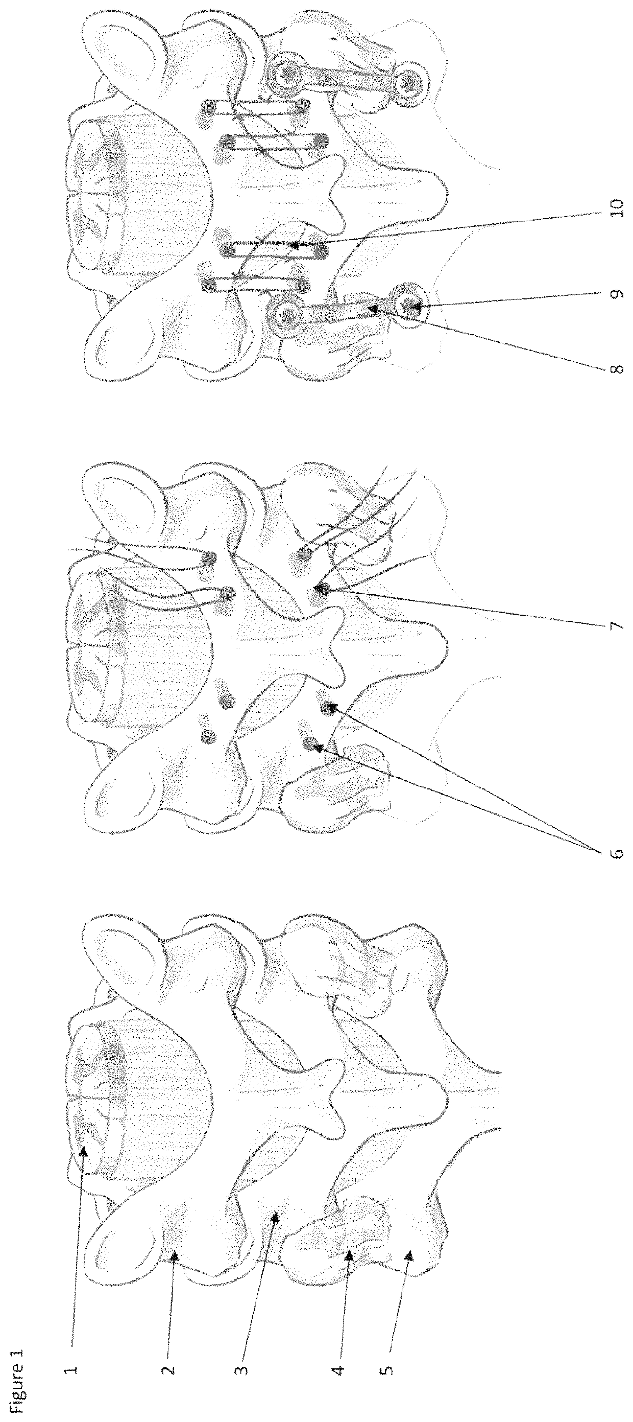 Surgical methods for the treatment of spinal stenosis