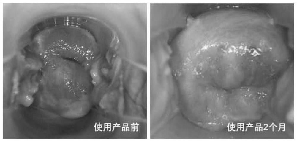 Gel for repairing cervical erosion and preparation method thereof