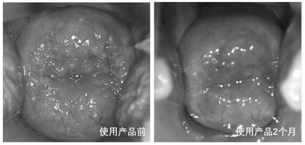 Gel for repairing cervical erosion and preparation method thereof