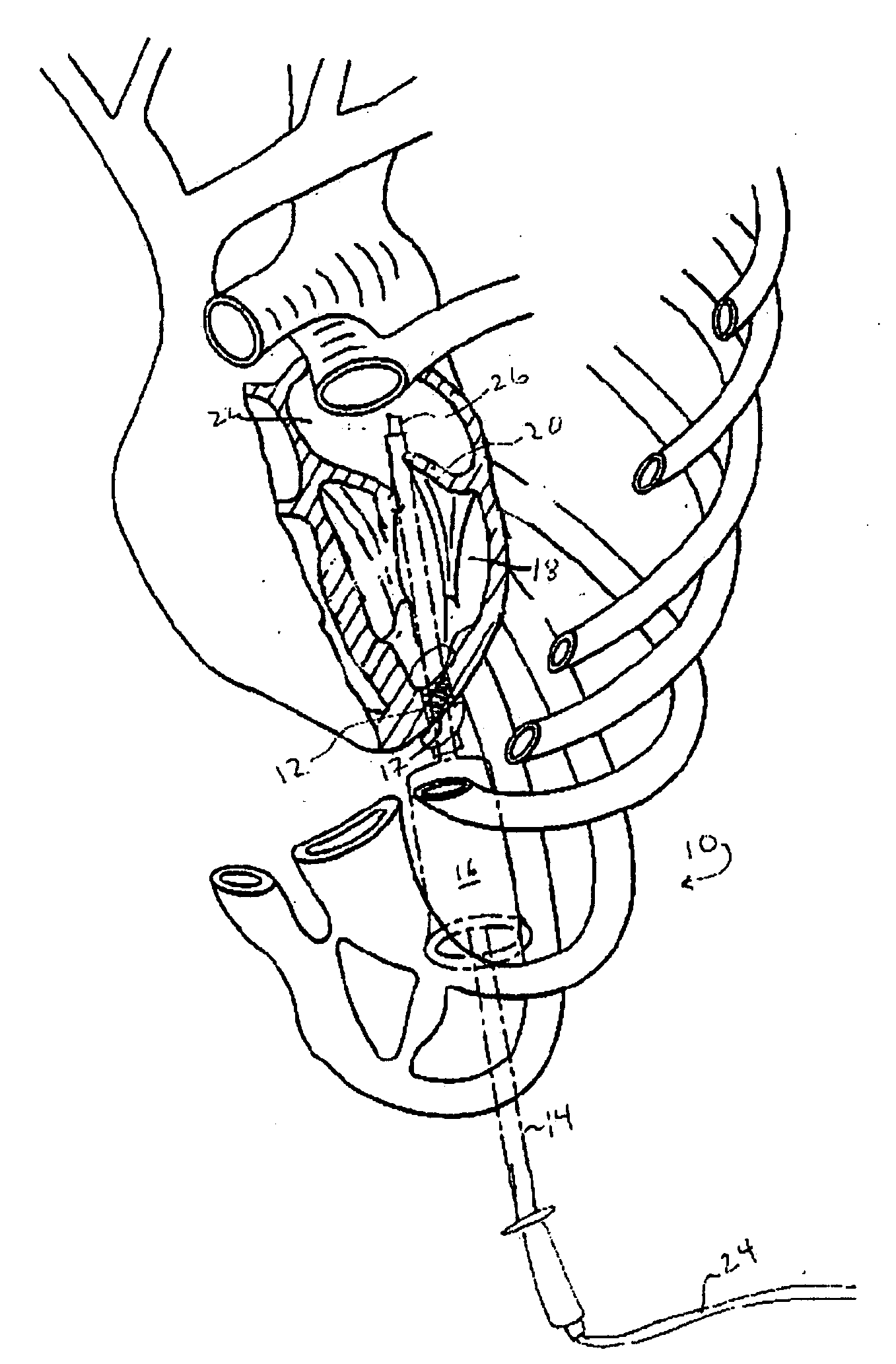 Methods for endocardial ablation