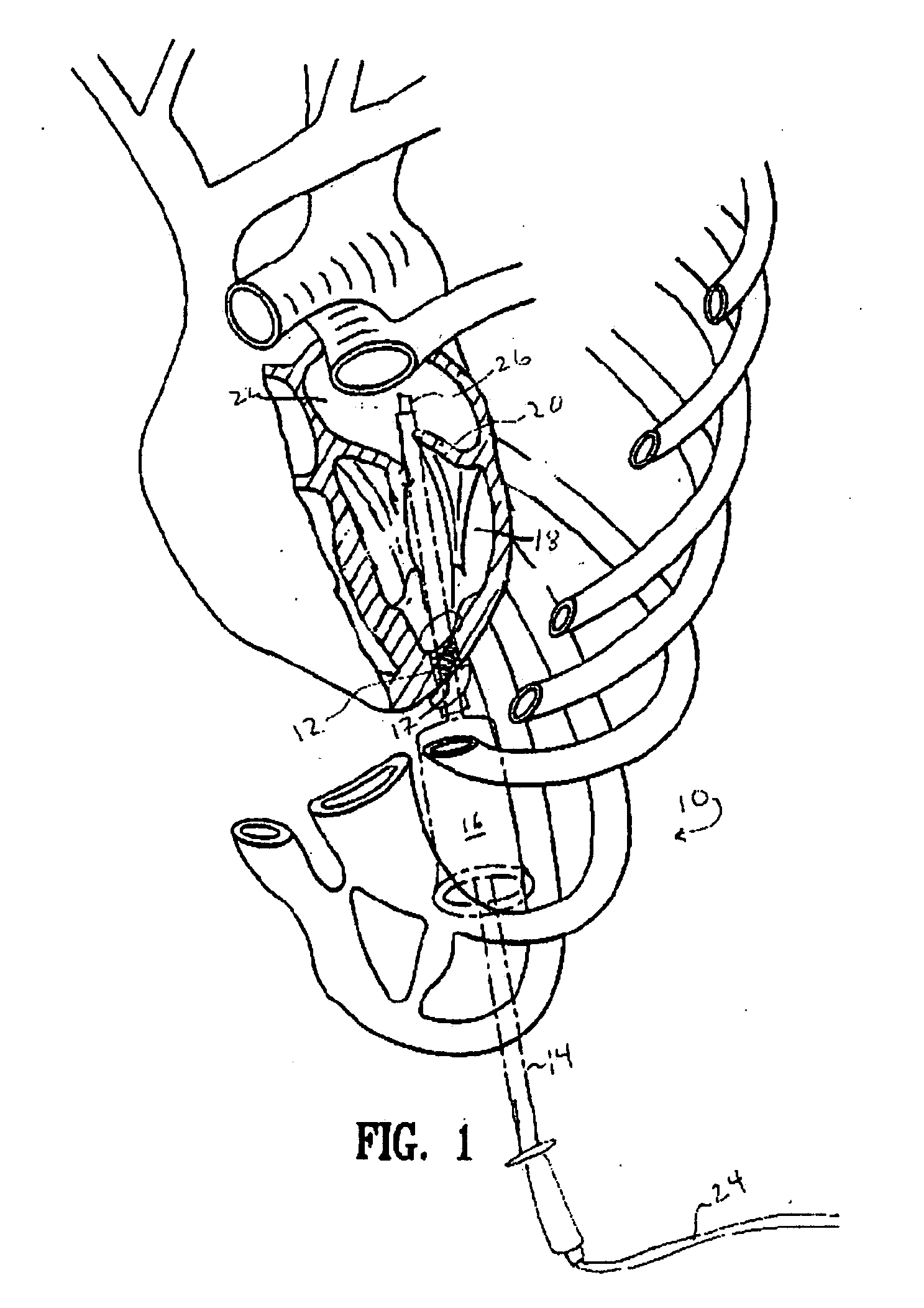 Methods for endocardial ablation