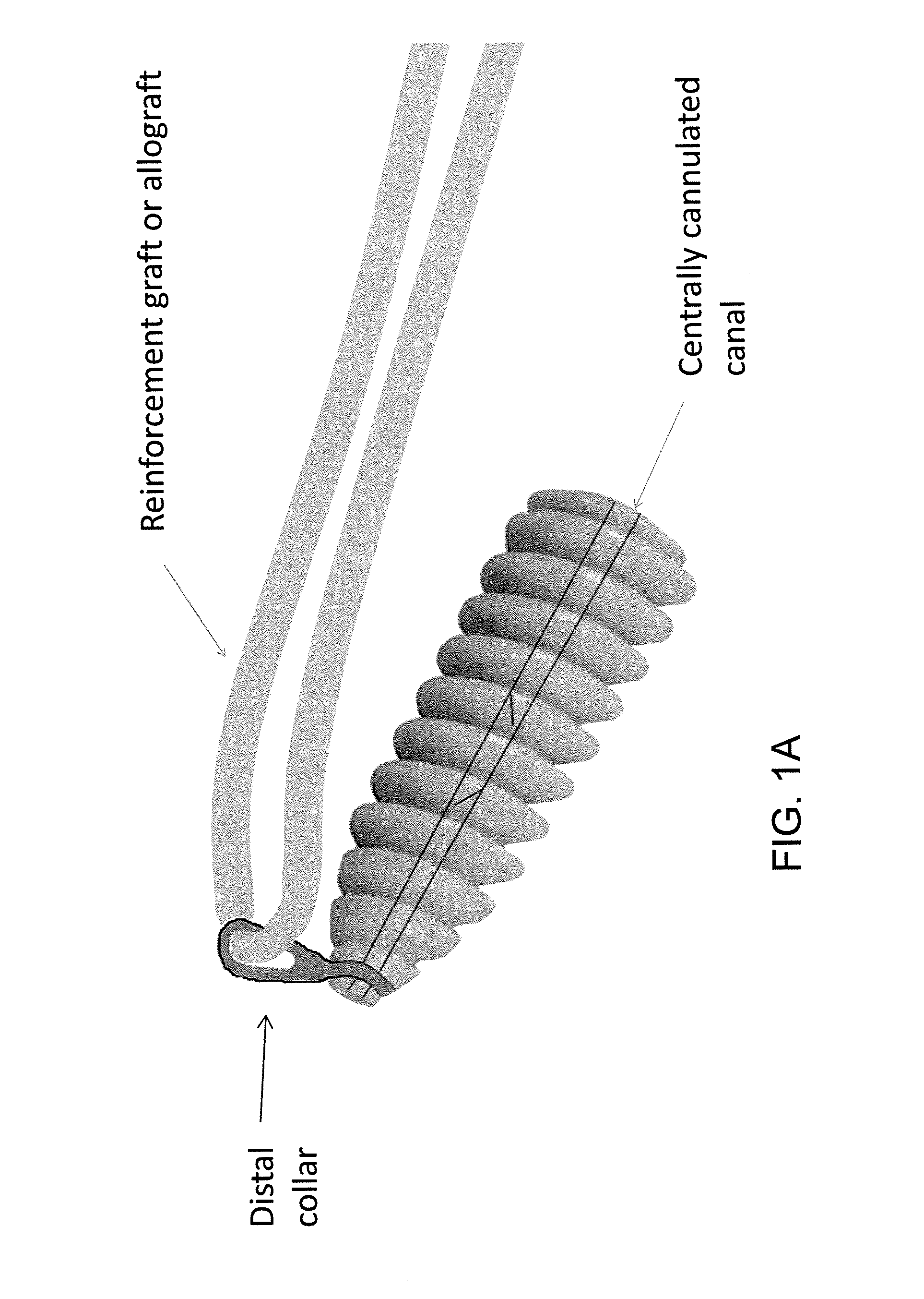 Implant and method for repair of the anterior cruciate ligament