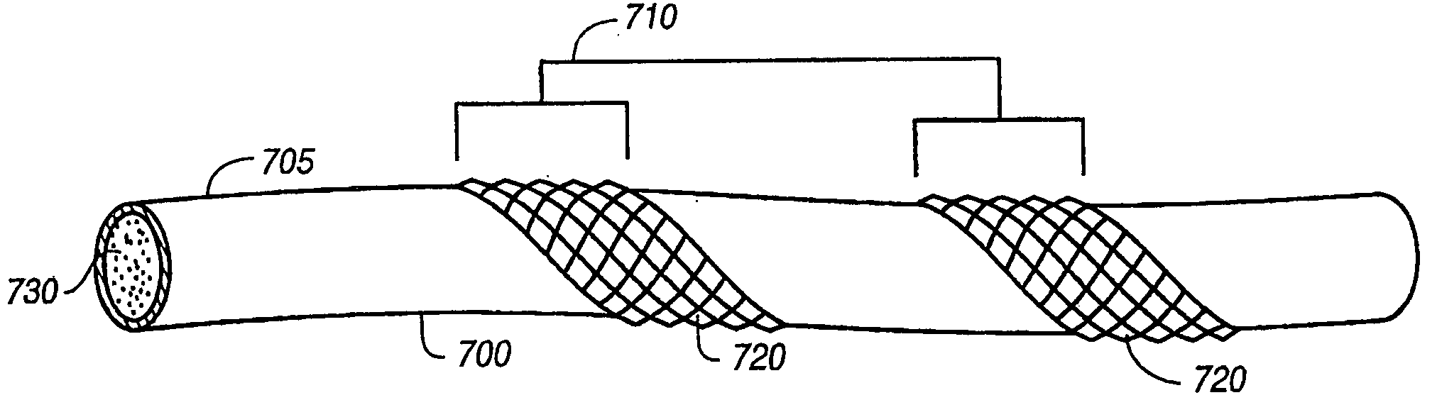 Ceramic reinforcement member for MRI devices