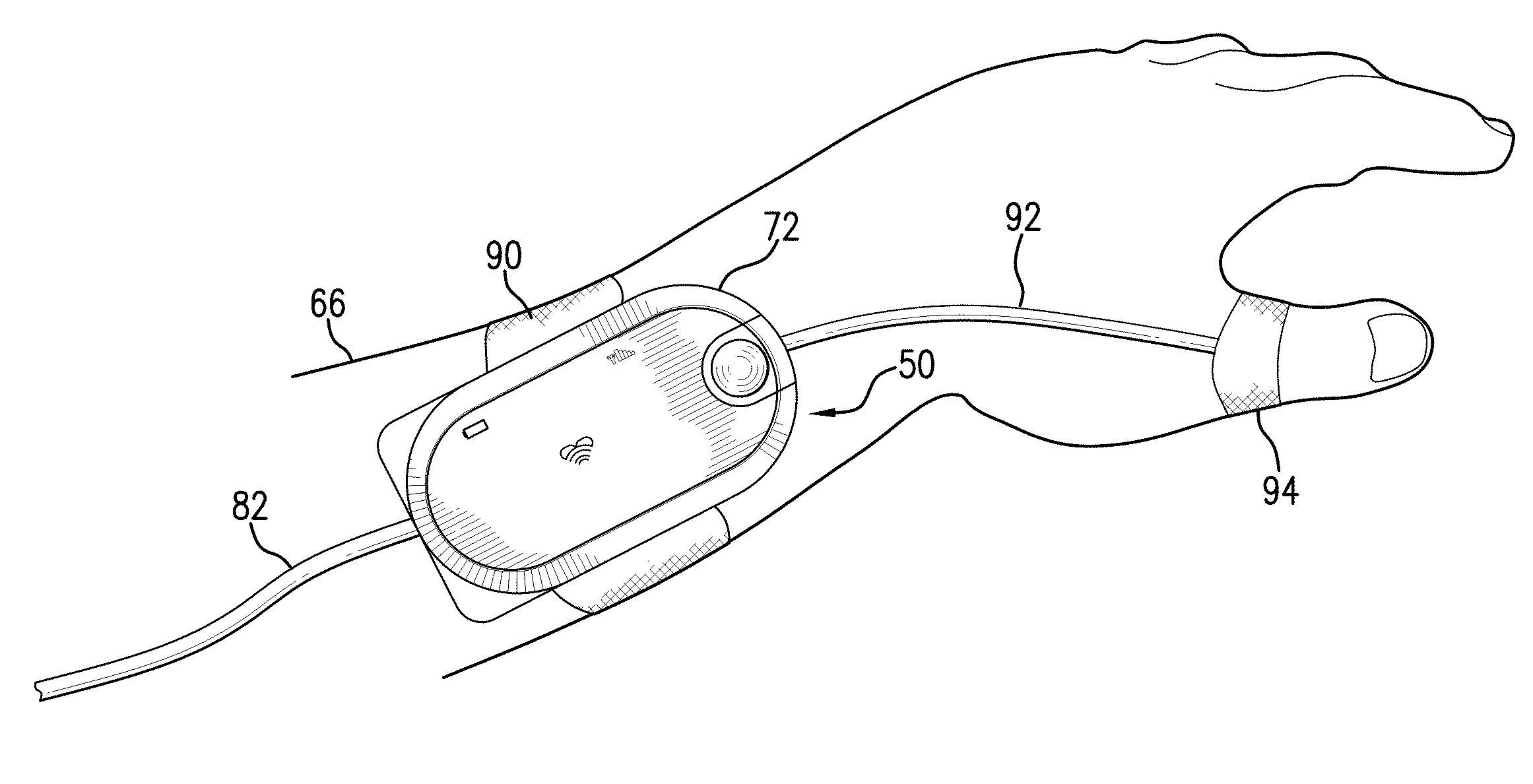 Body-worn vital sign monitor