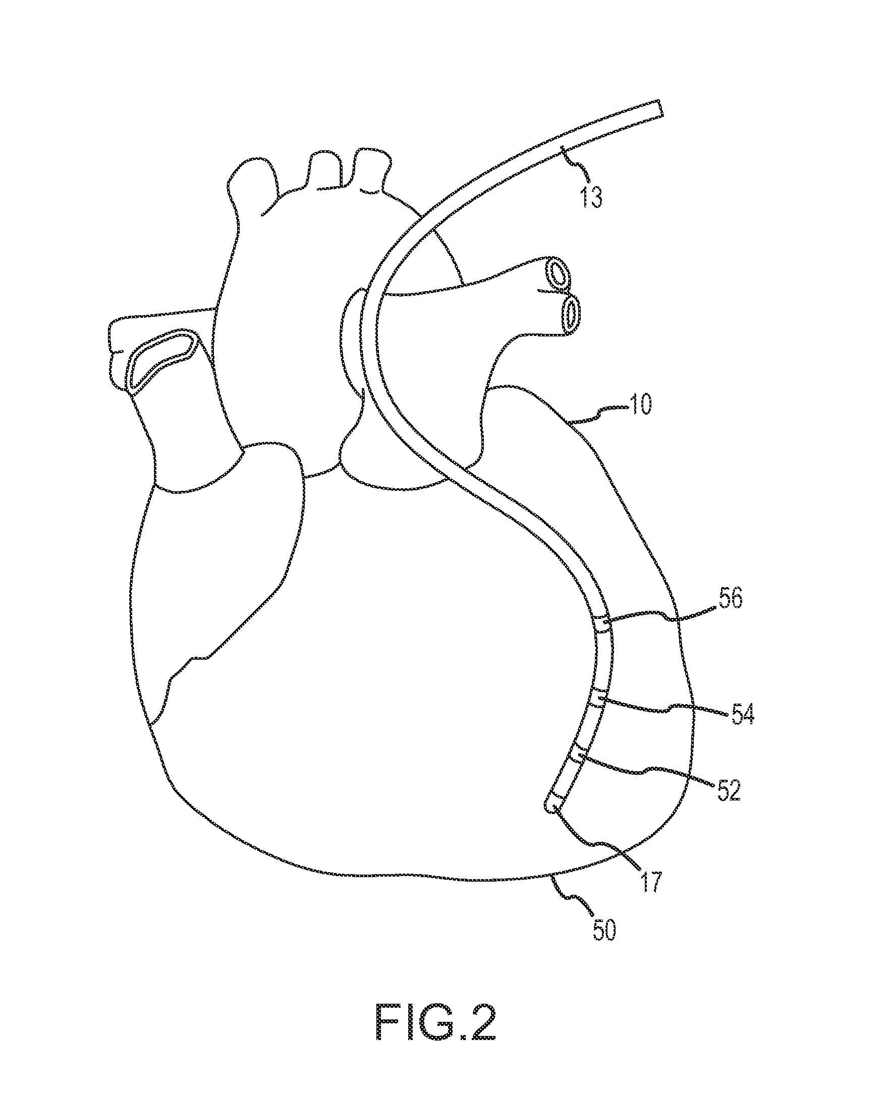 Methods and systems for filtering respiration noise from localization data