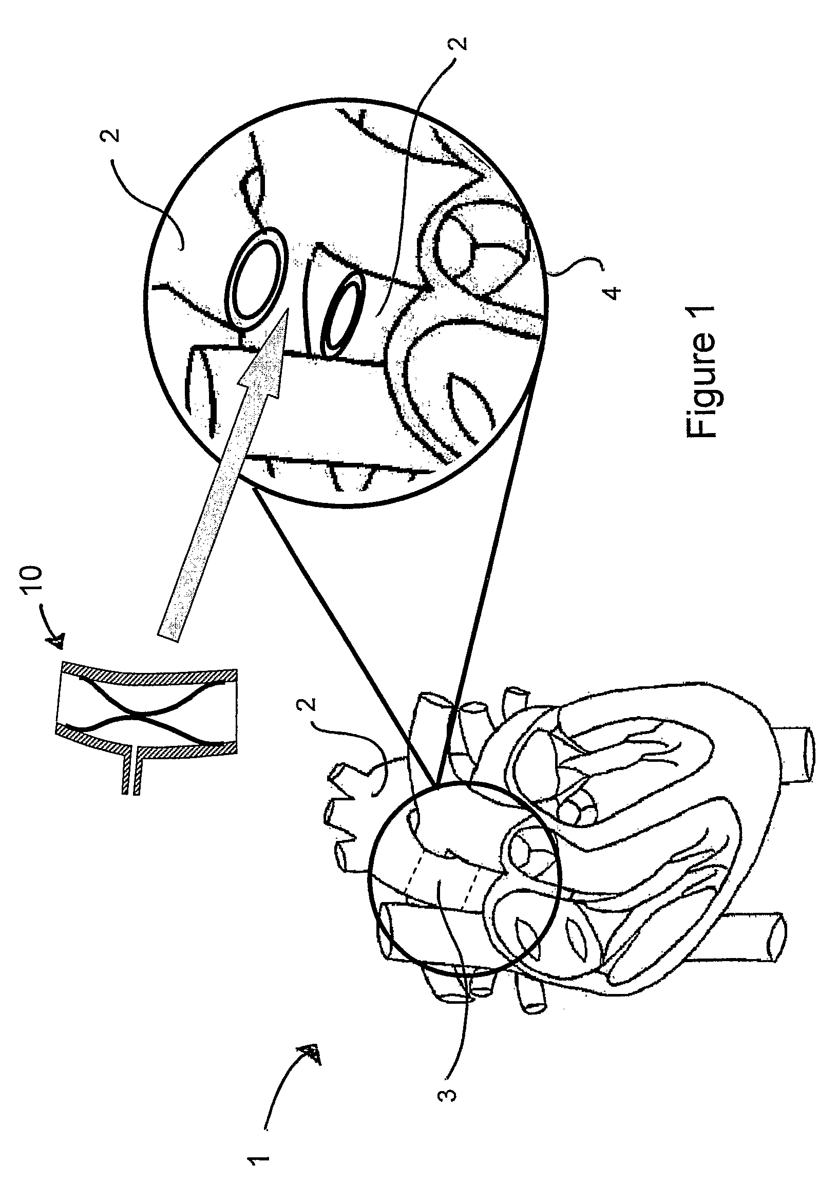 Pulsatile blood pump