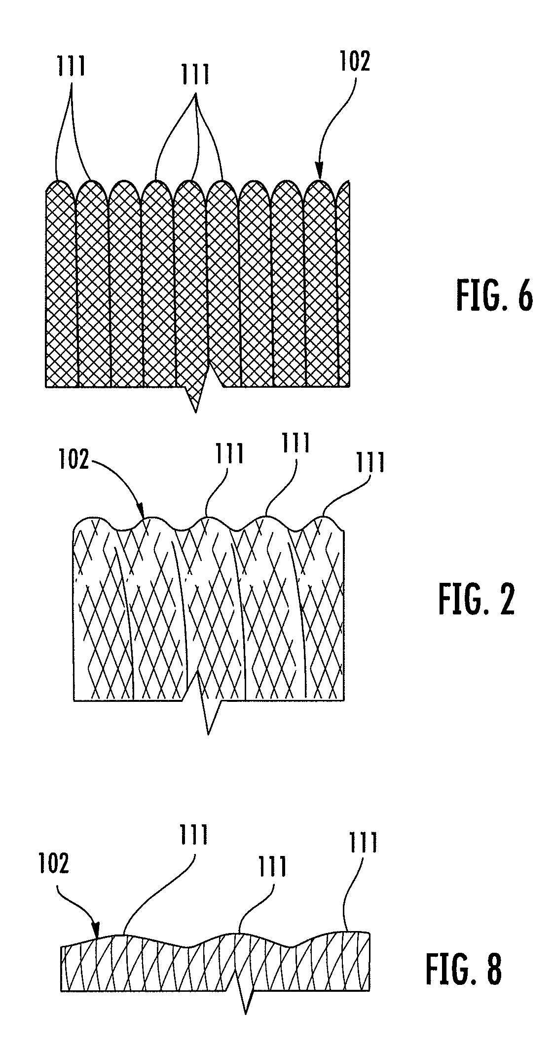 Medical device including corrugated braid and associated method