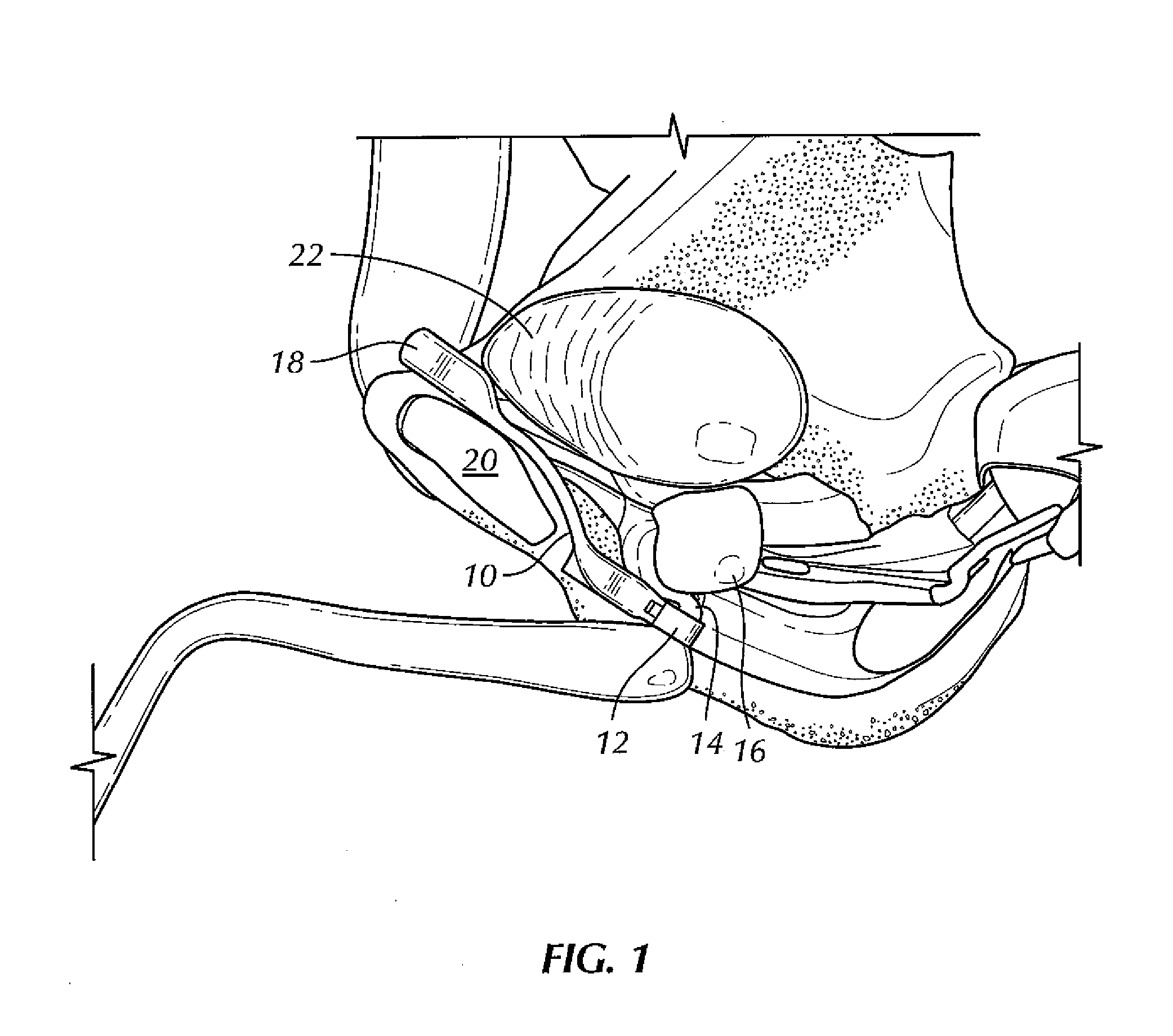 Patient-manipulable device for ameliorating incontinence