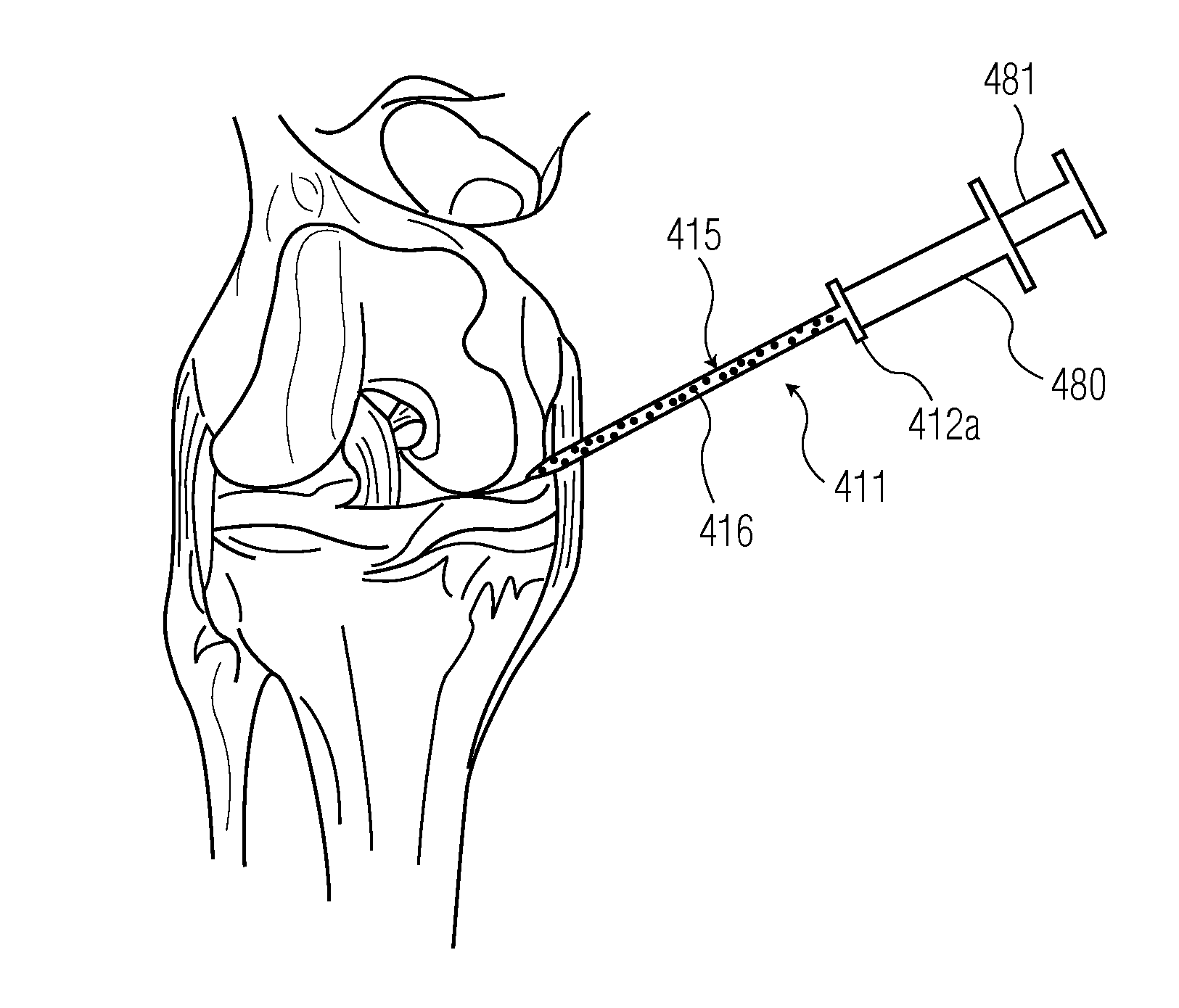 Device and method to activate platelets