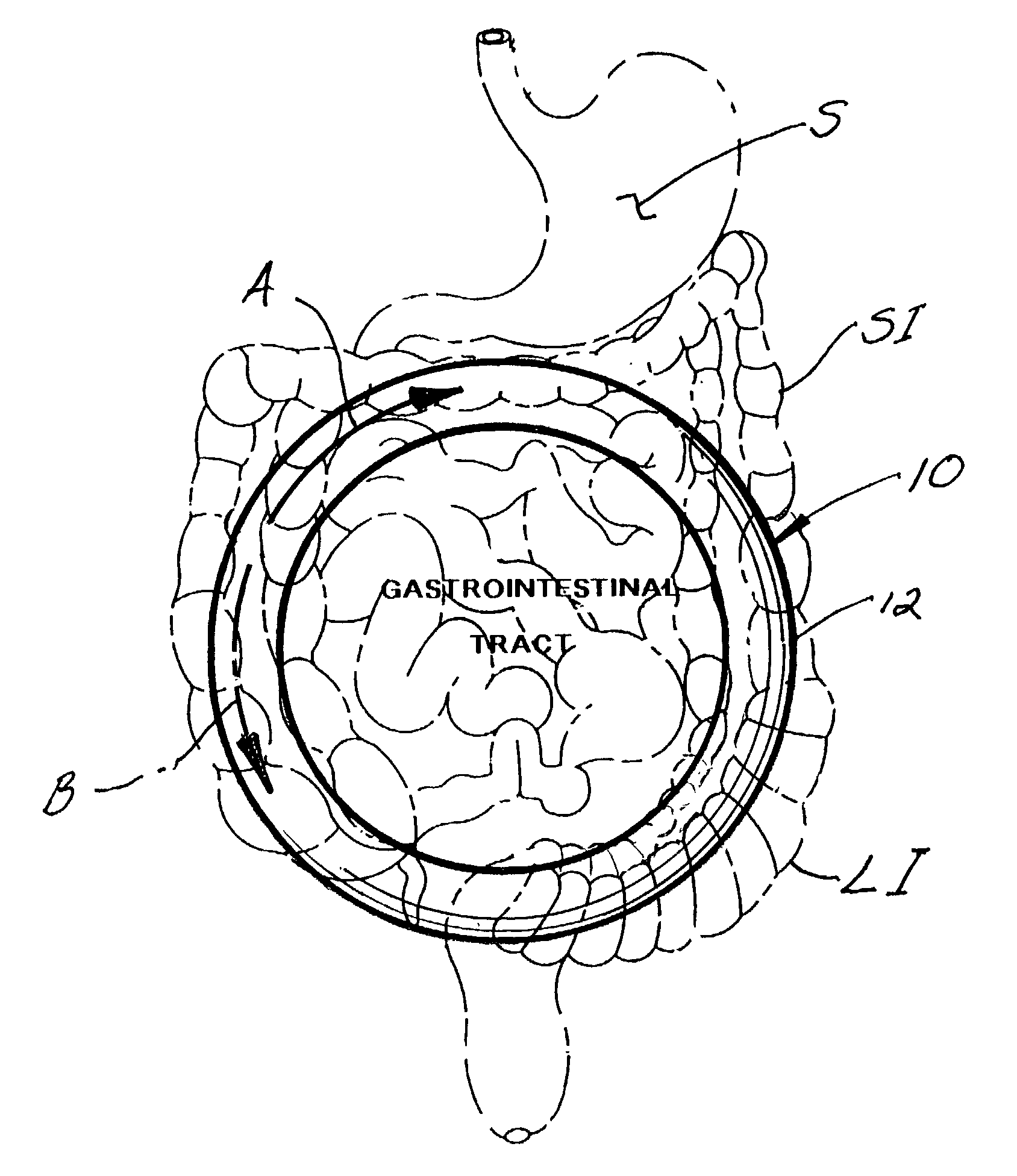 Electronic gastro-intestinal stimulation device