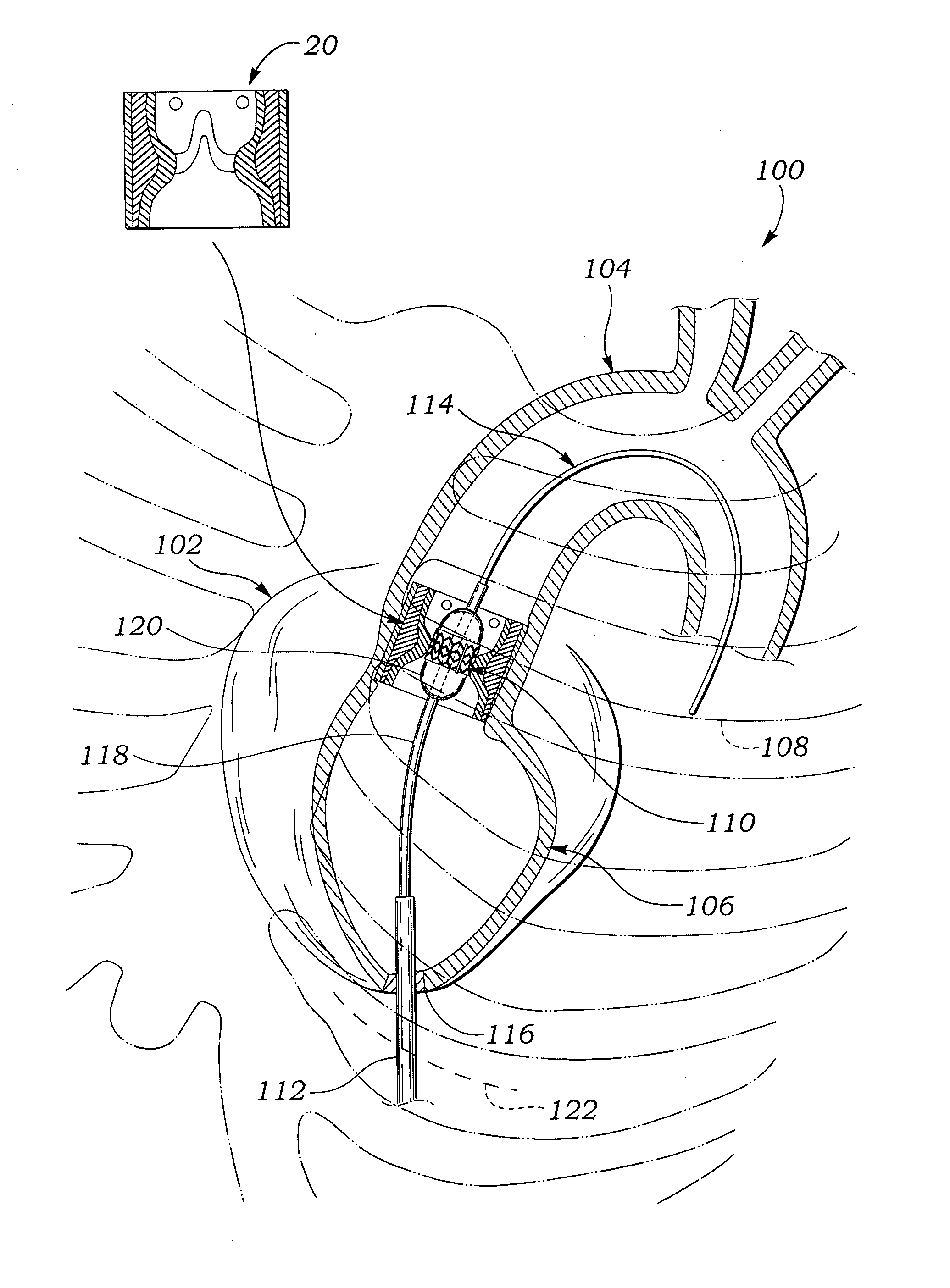 Simulated heat and valve root for training and testing