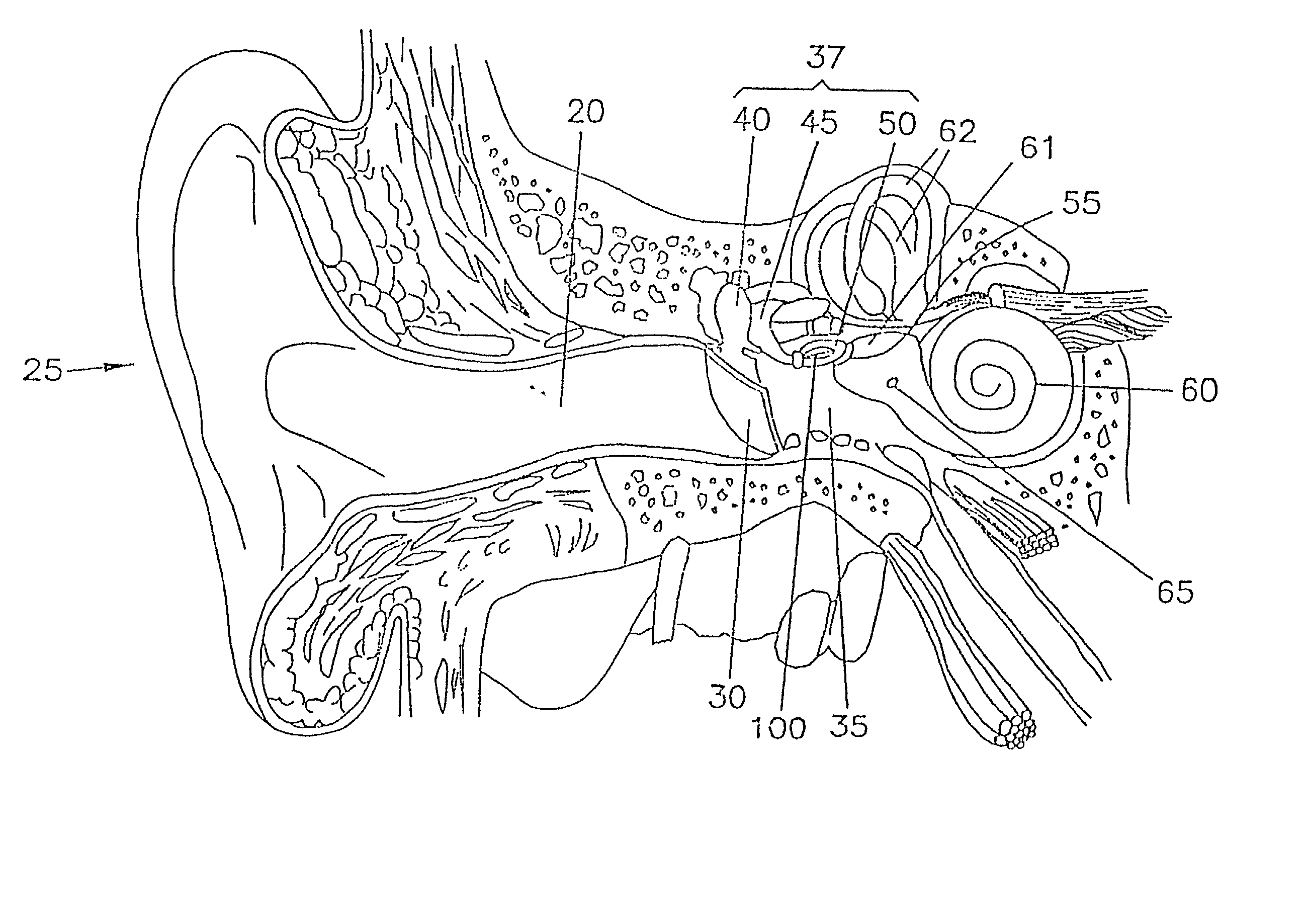 Wireless communications system for implantable hearing aid