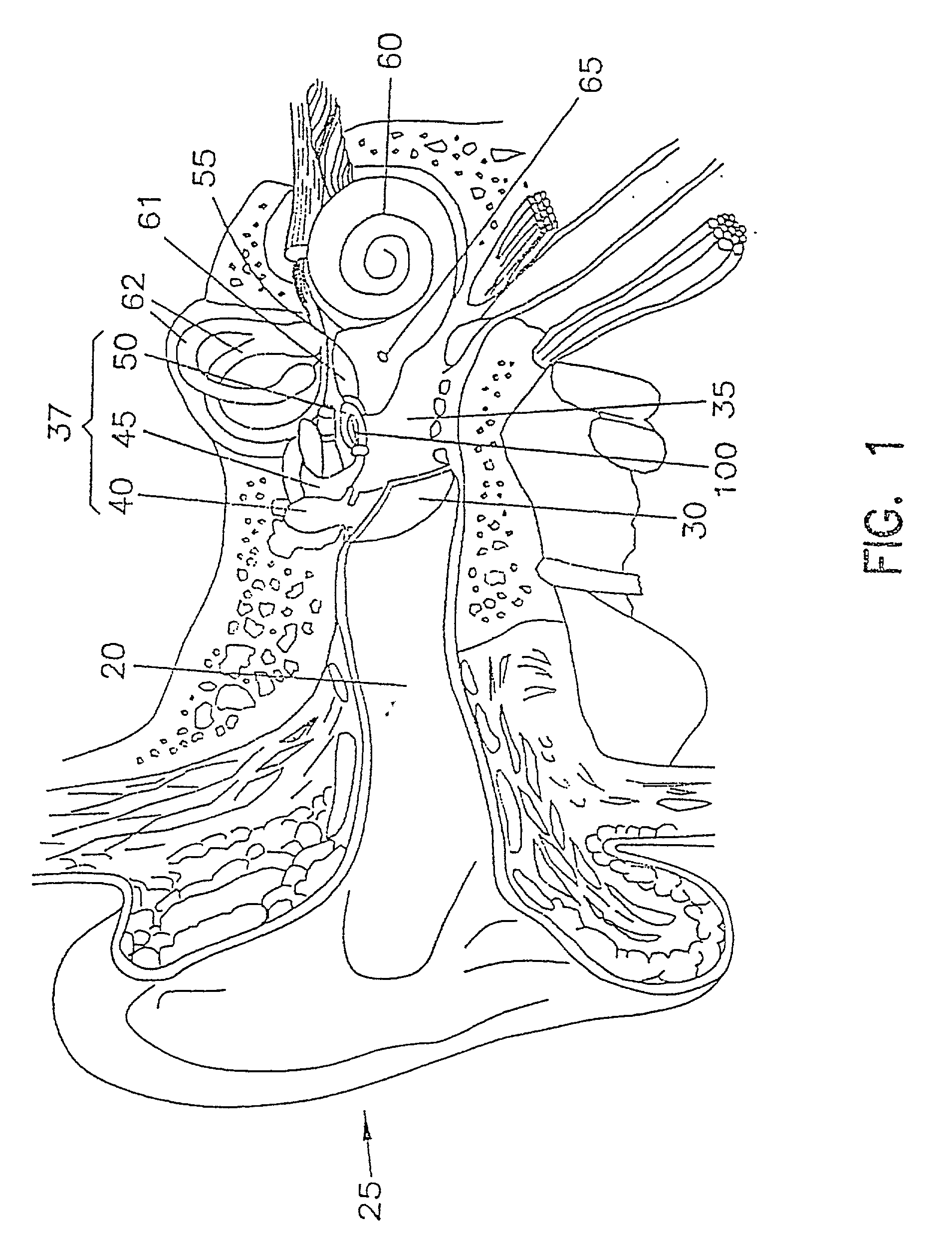 Wireless communications system for implantable hearing aid