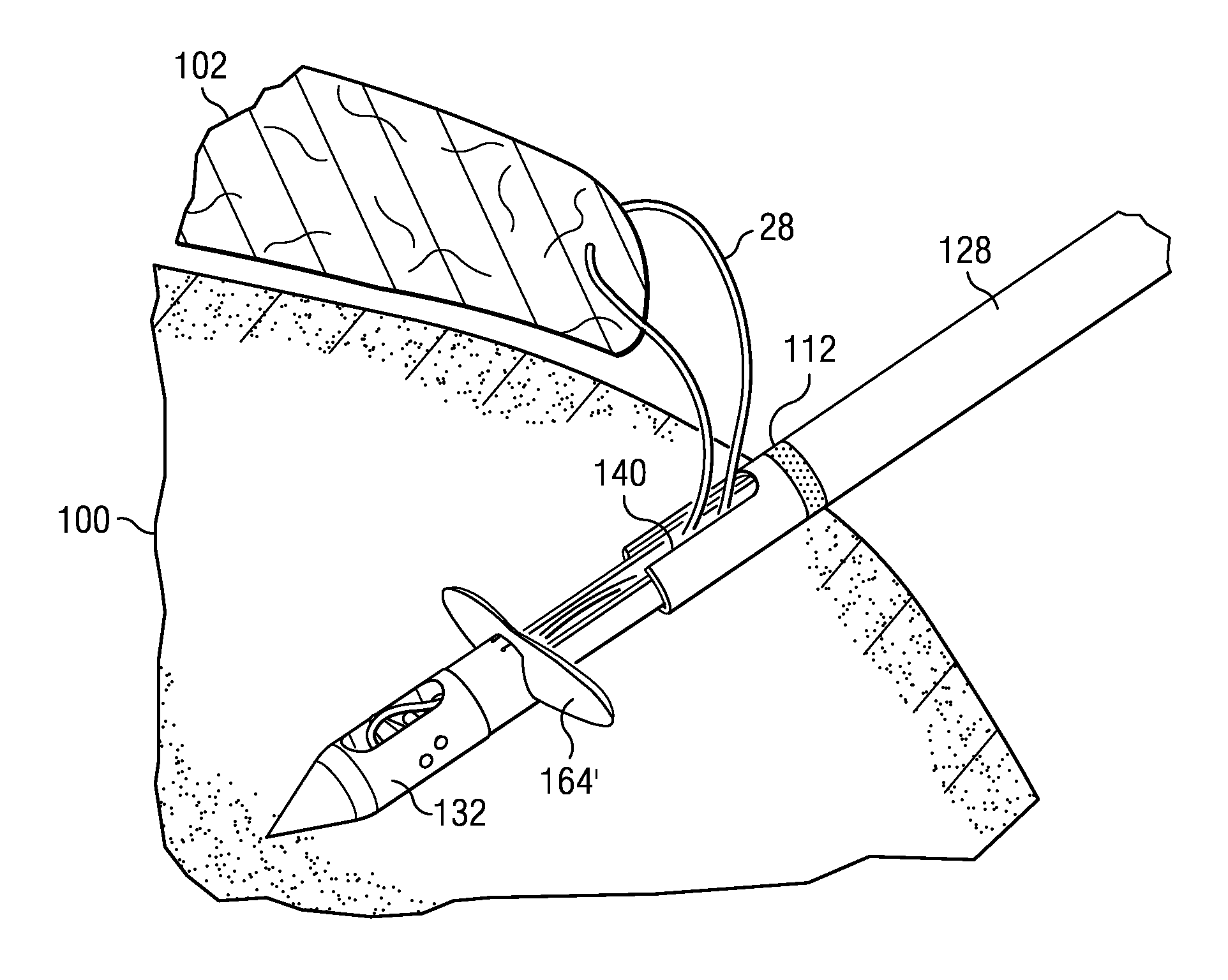 Rotating locking member suture anchor and method for soft tissue repair