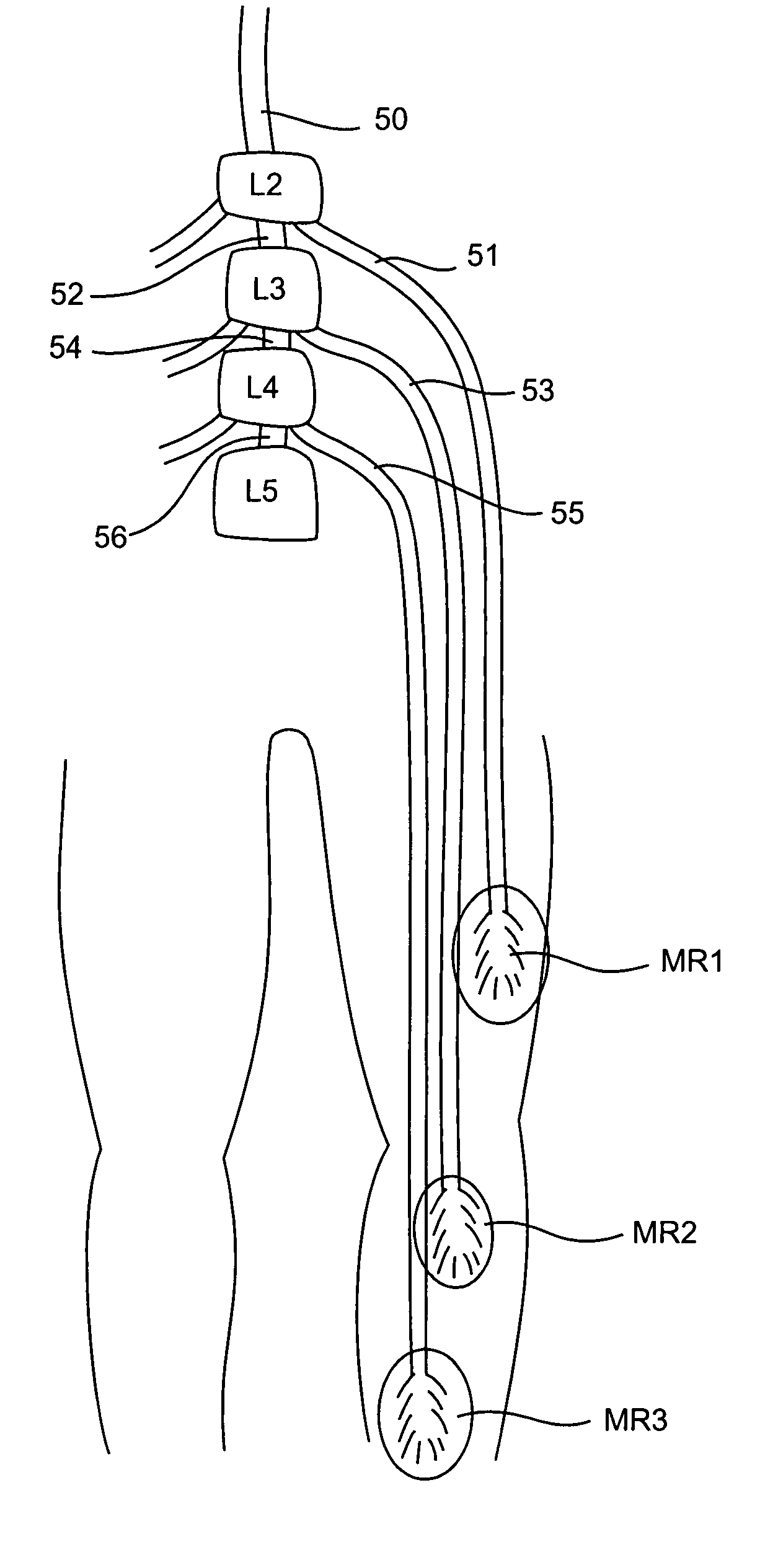 Electromyography system