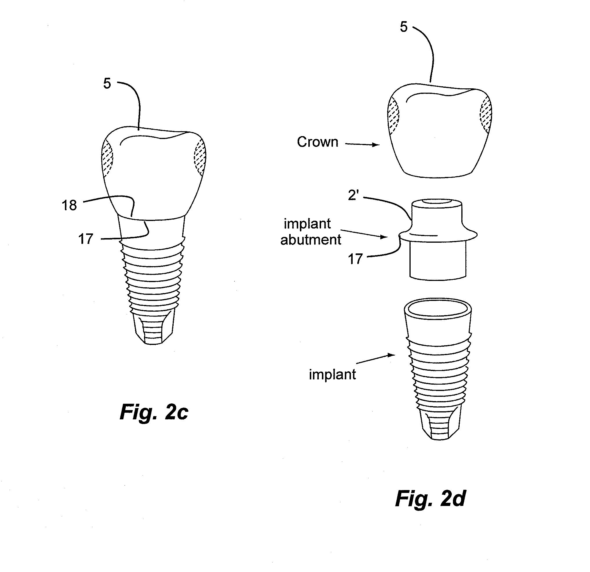 Method of making a dental prosthesis