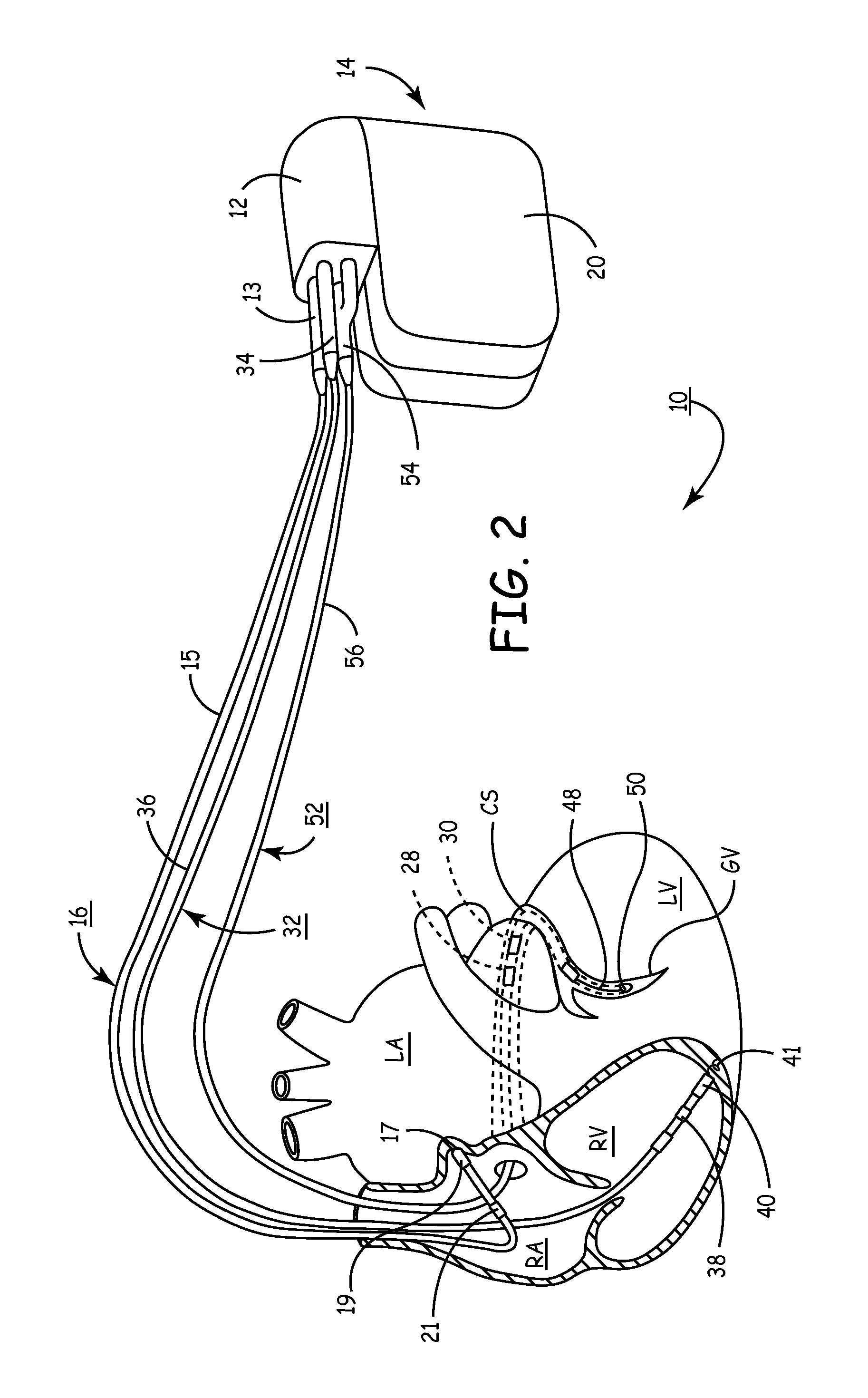 Fusion pacing enhancements