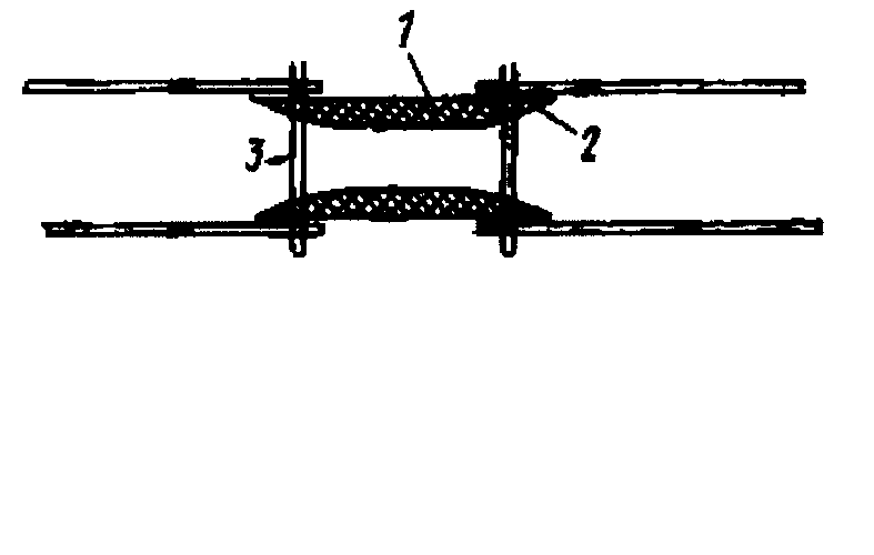 Method For Radical Removal of Parasagittal Meningioma