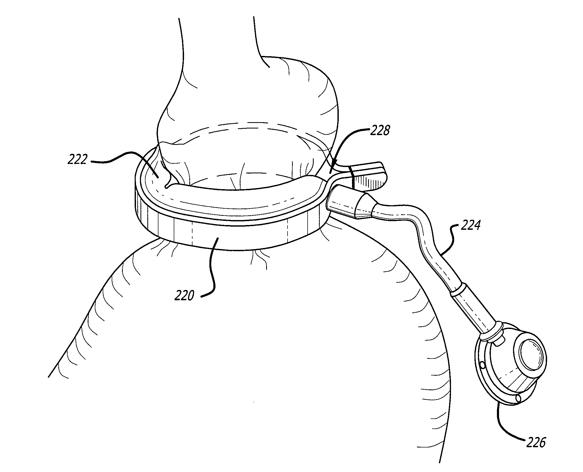 Assembly and method for automatically controlling pressure for a gastric band