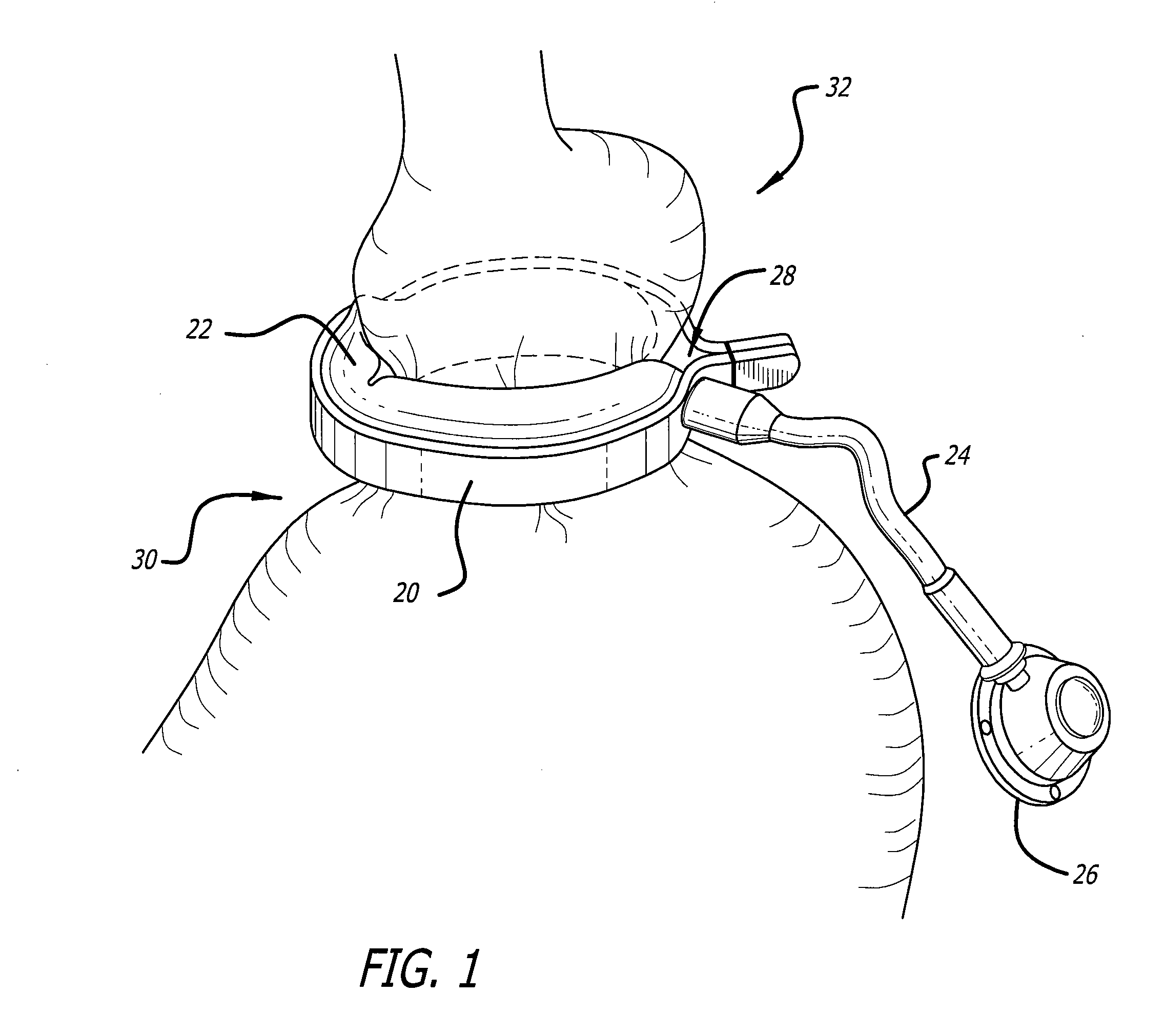 Assembly and method for automatically controlling pressure for a gastric band