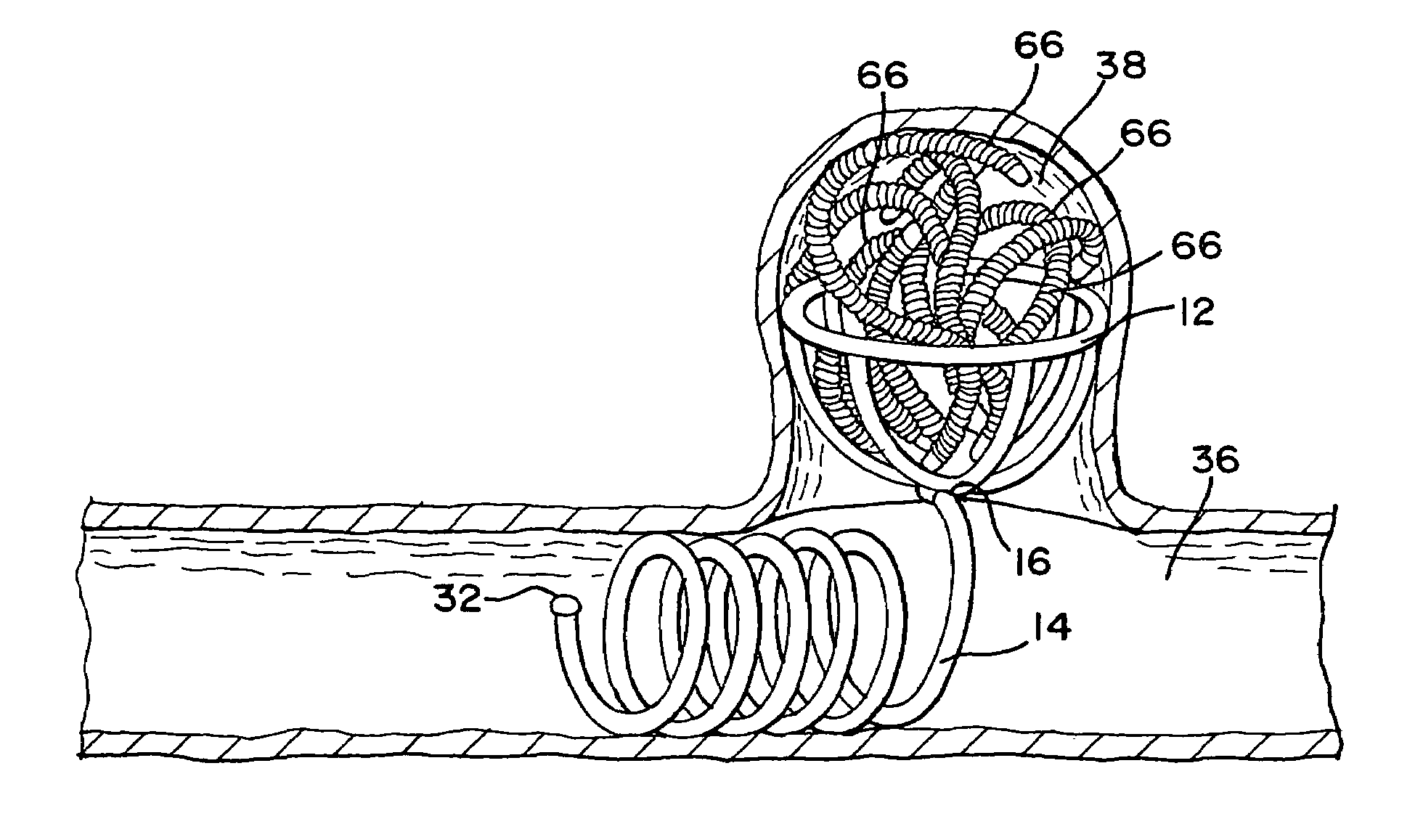 Stent aneurysm embolization device