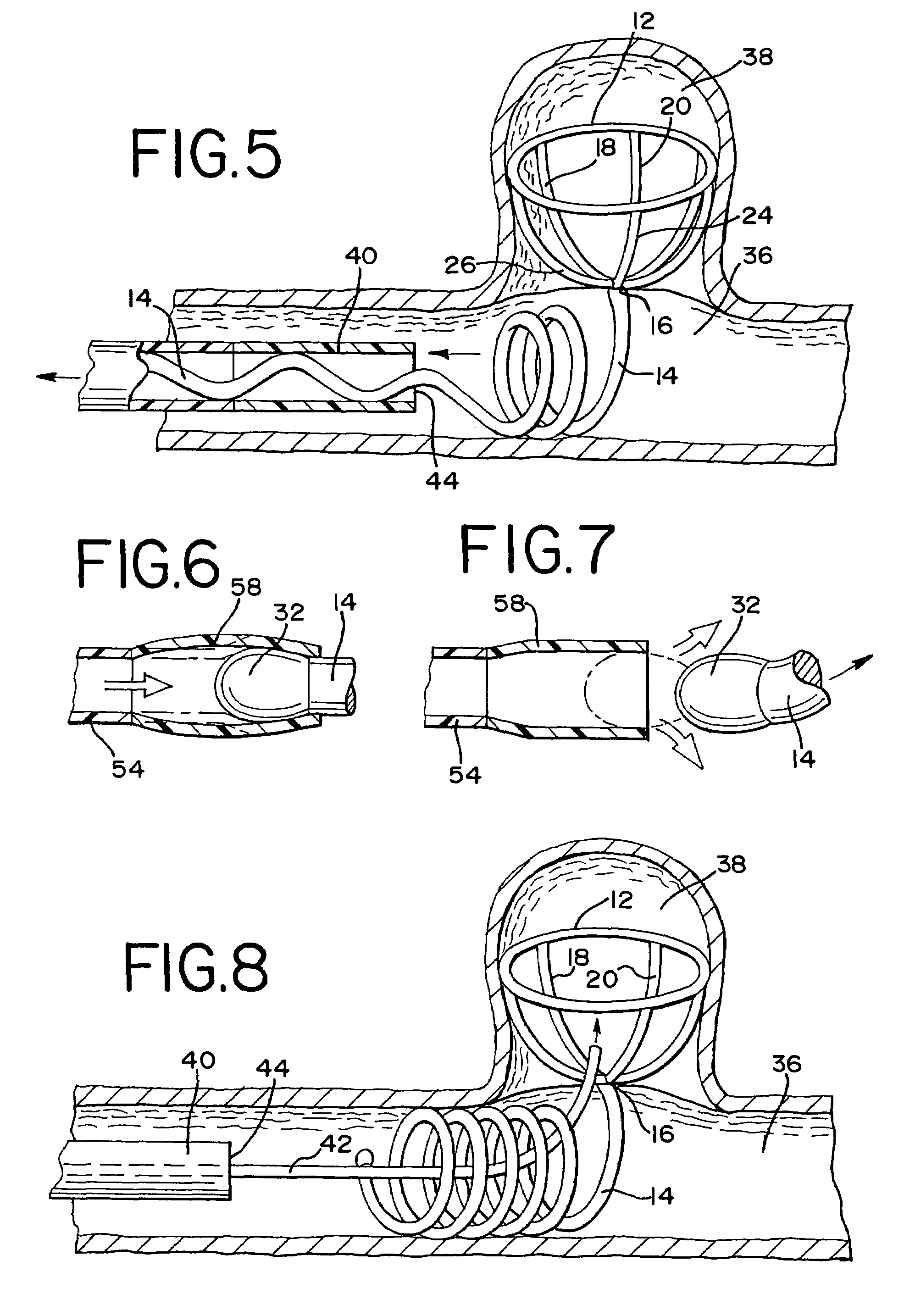 Stent aneurysm embolization device