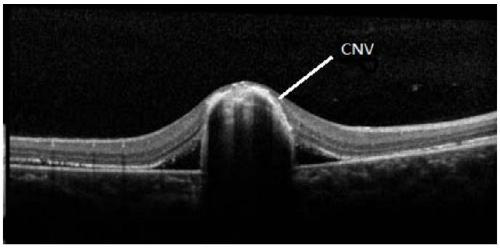 BEST1 novel mutation disease-causing gene for retinosis diseases and kit thereof