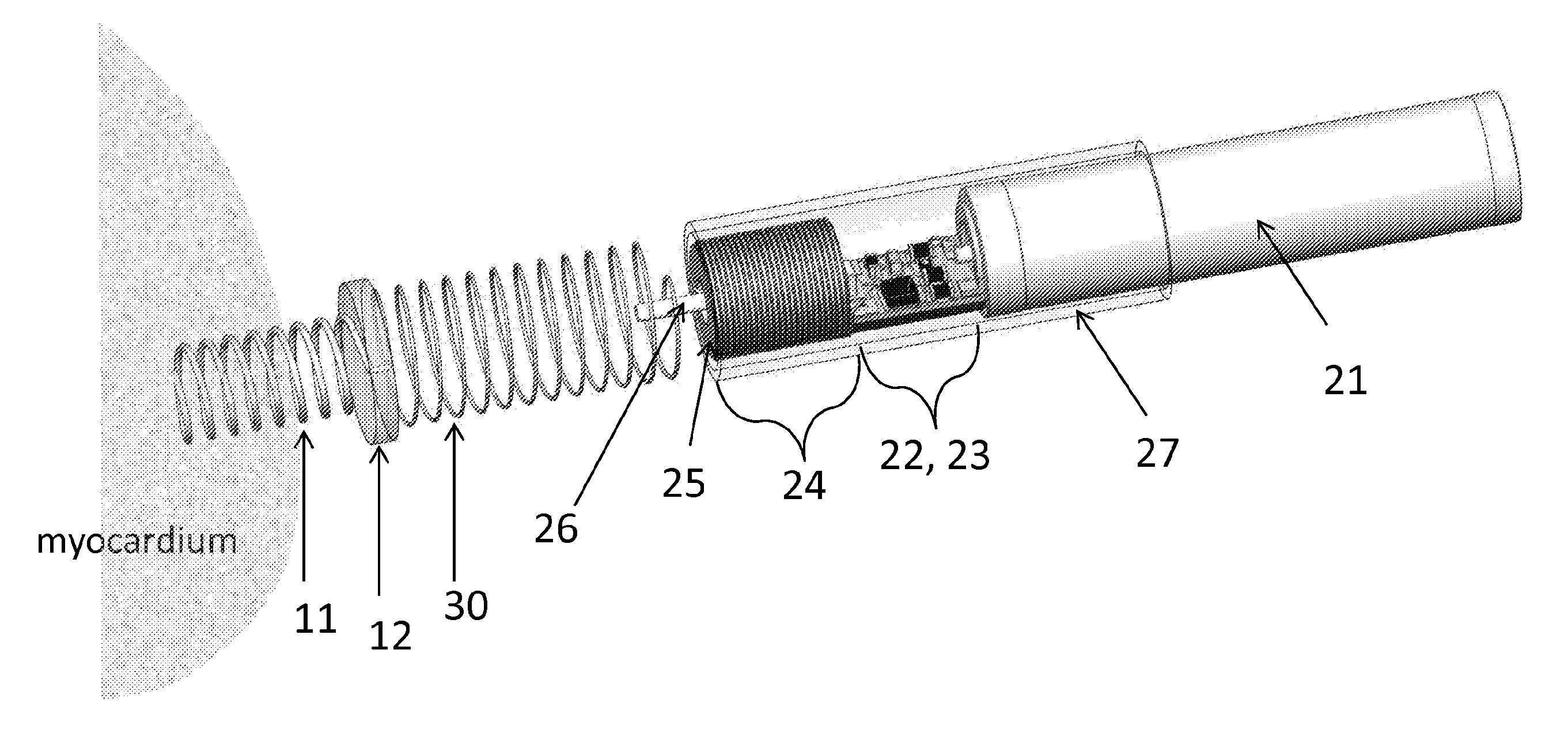 Minimally invasive epicardial pacemaker