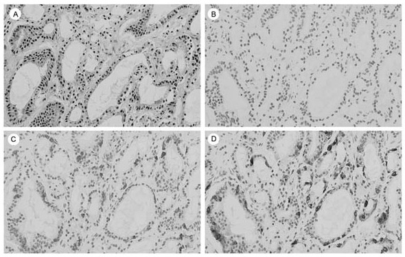 Application of insulinoma-related protein 1 as marker for diagnosing or prognostically evaluating prostate neuroendocrine small cell carcinoma