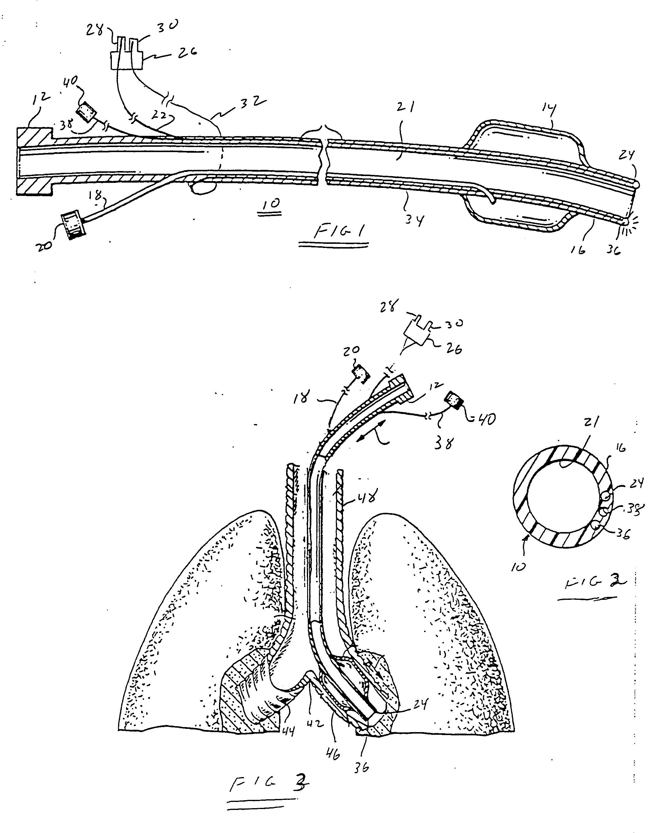 Endotracheal camera