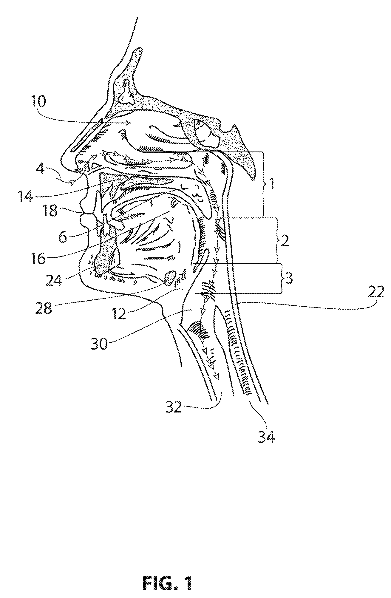 Systems and methods for treatment of sleep apnea