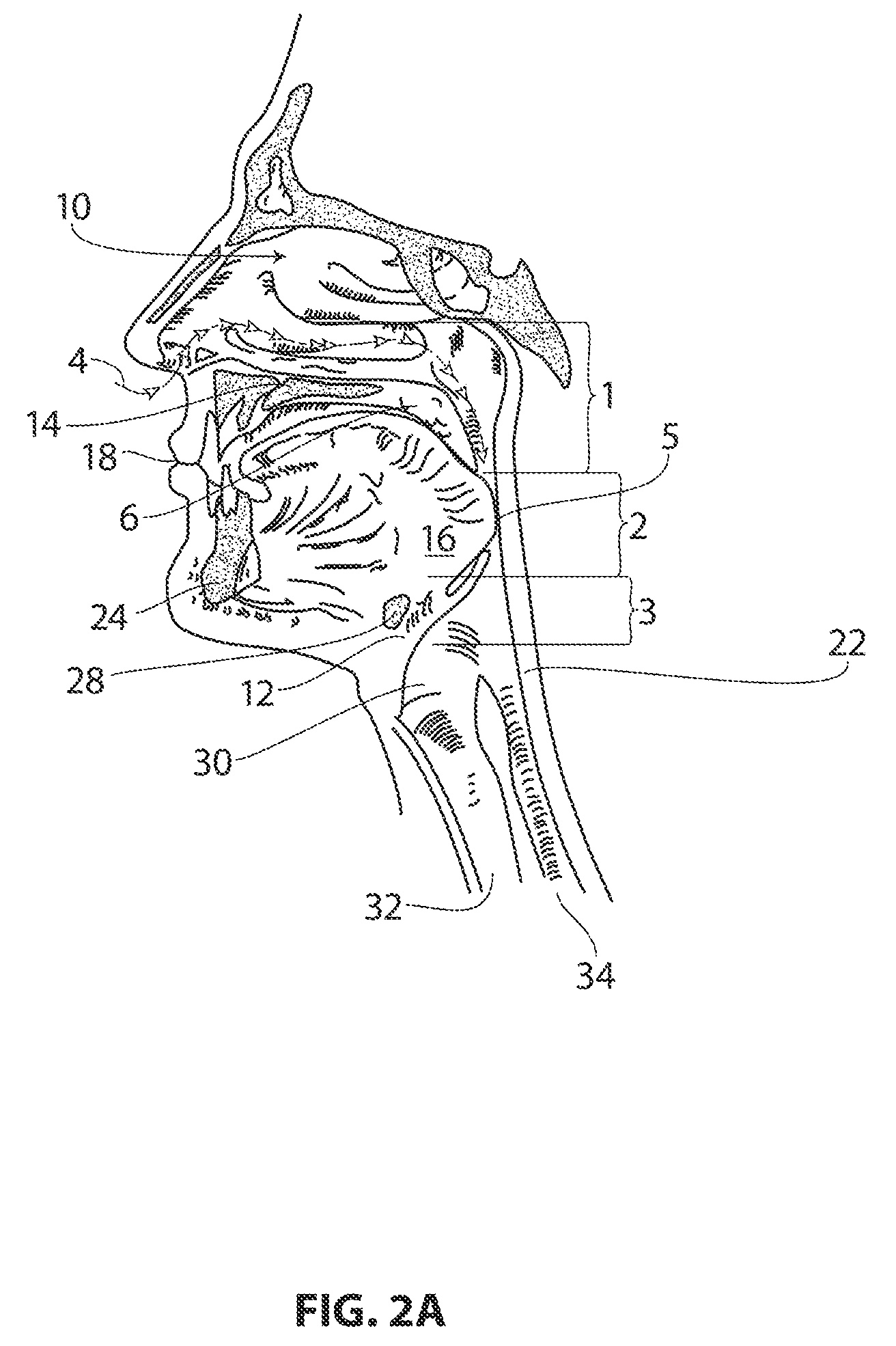 Systems and methods for treatment of sleep apnea