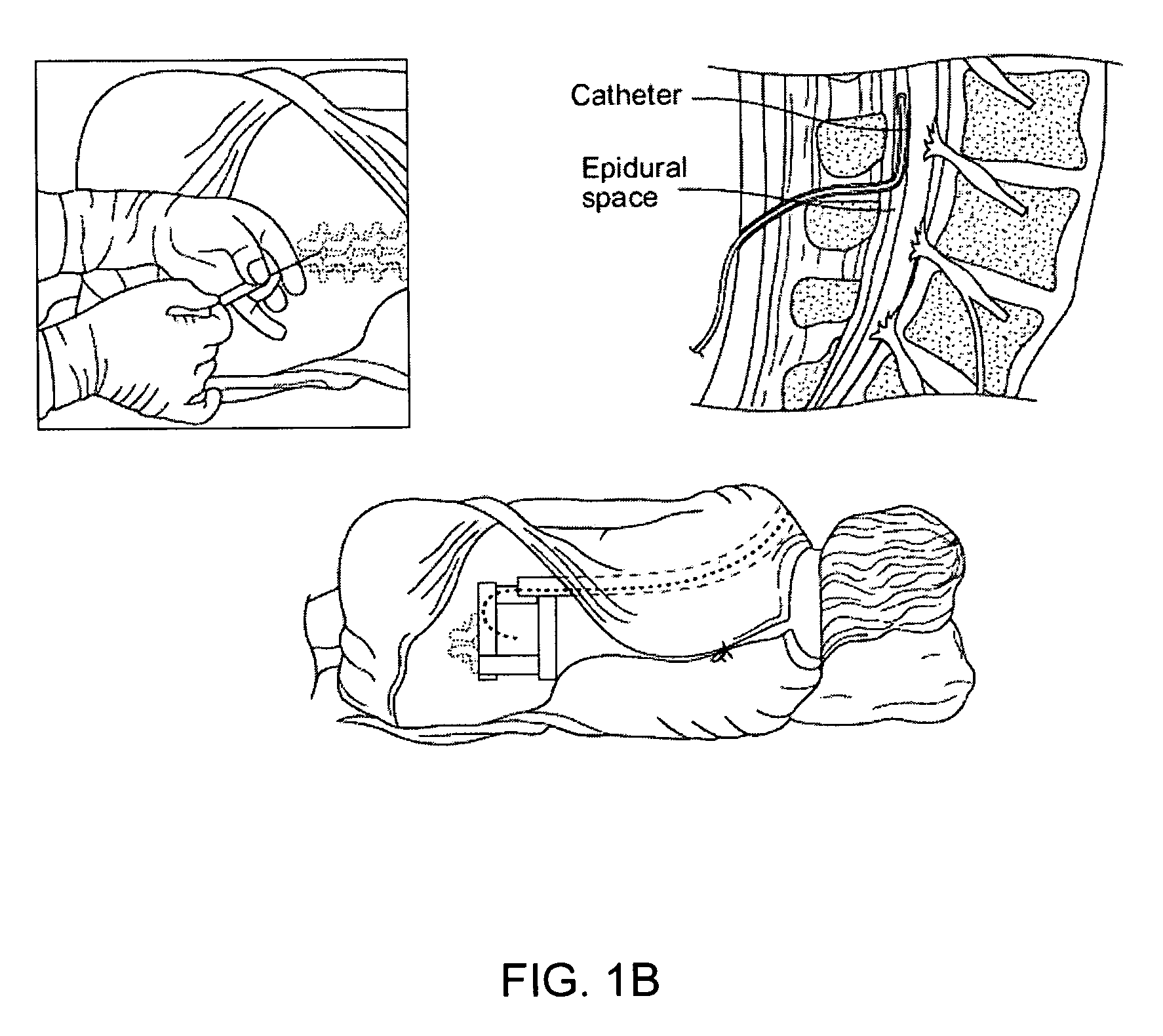 Spinal canal access and probe positioning, devices and methods