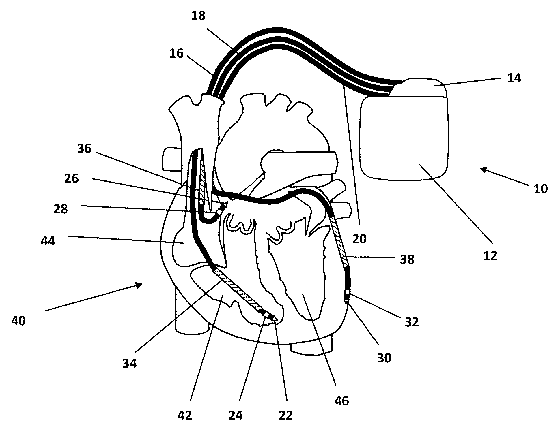 Implantable heart monitoring device