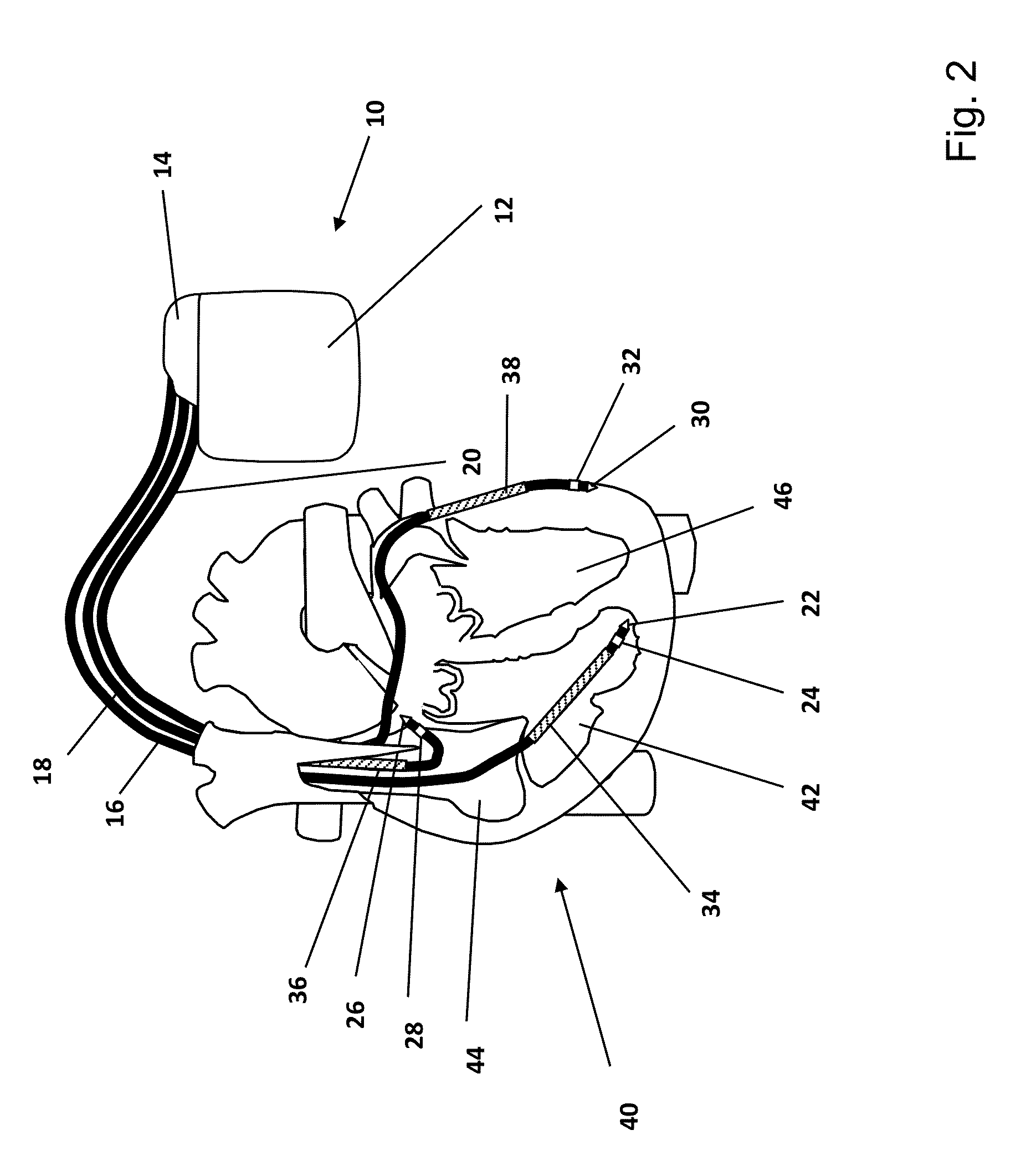 Implantable heart monitoring device