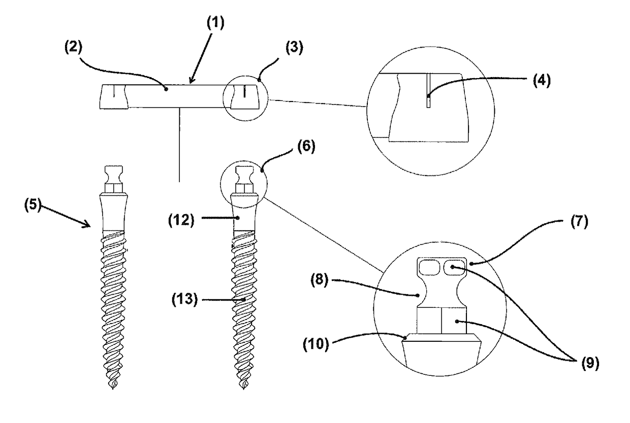 Prosthetic retention system for edentulous patients consisting of a prefabricated bar and two implants