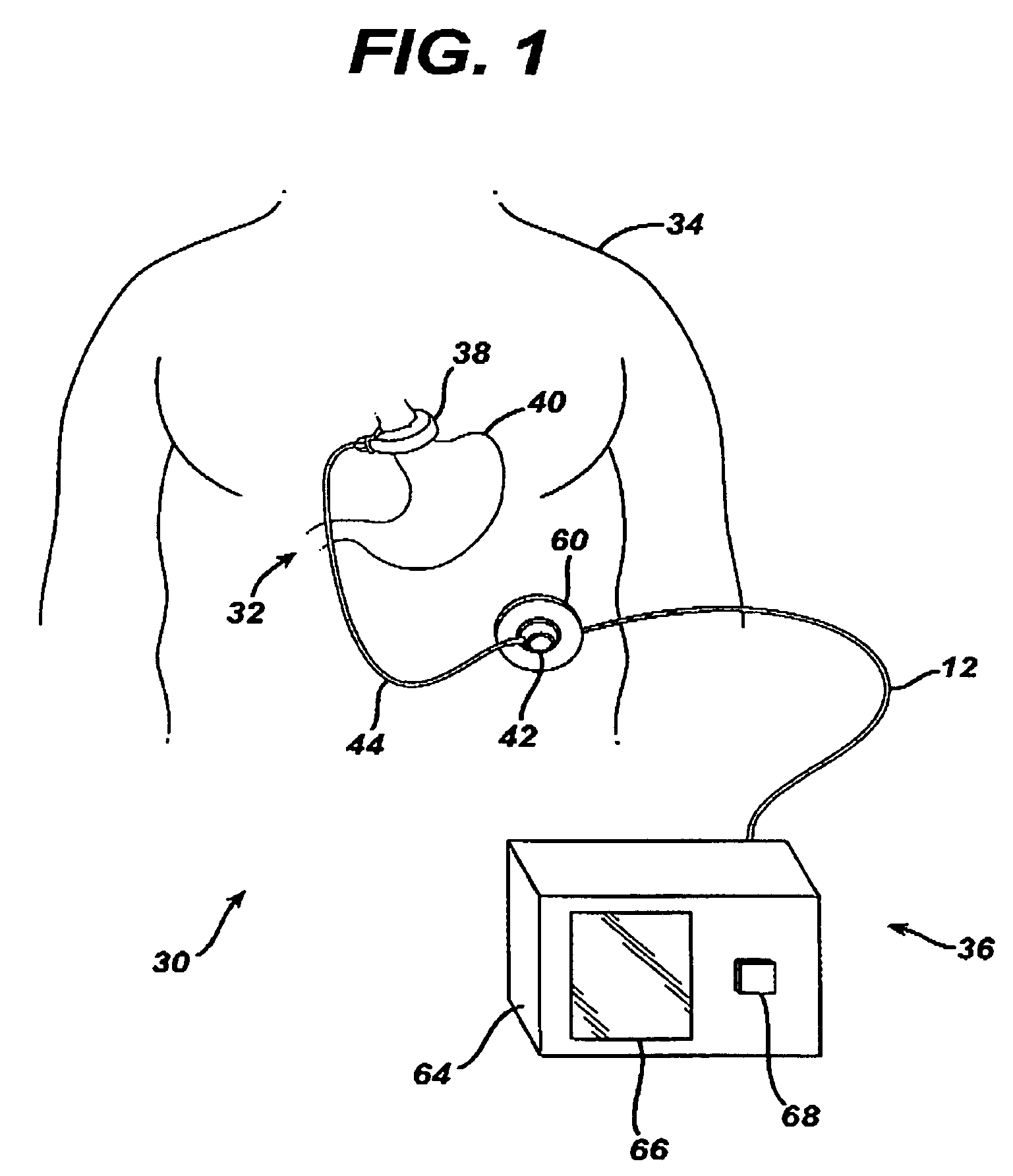 Device for non-invasive measurement of fluid pressure in an adjustable restriction device