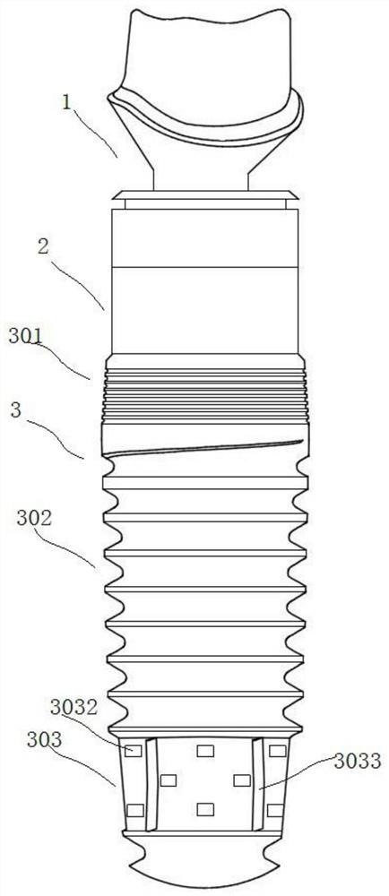 Dental implant