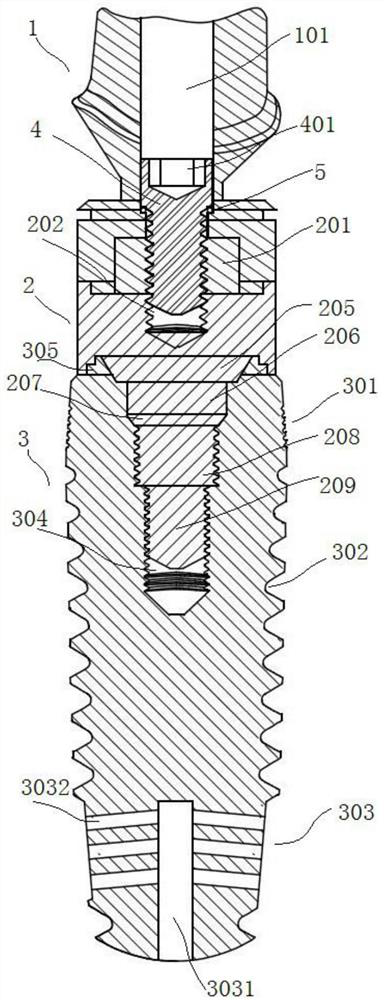 Dental implant