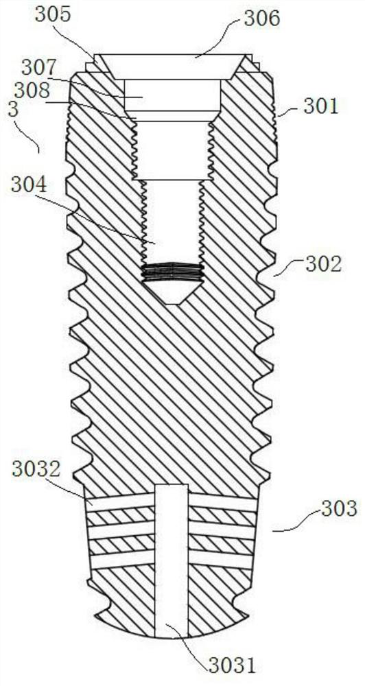 Dental implant