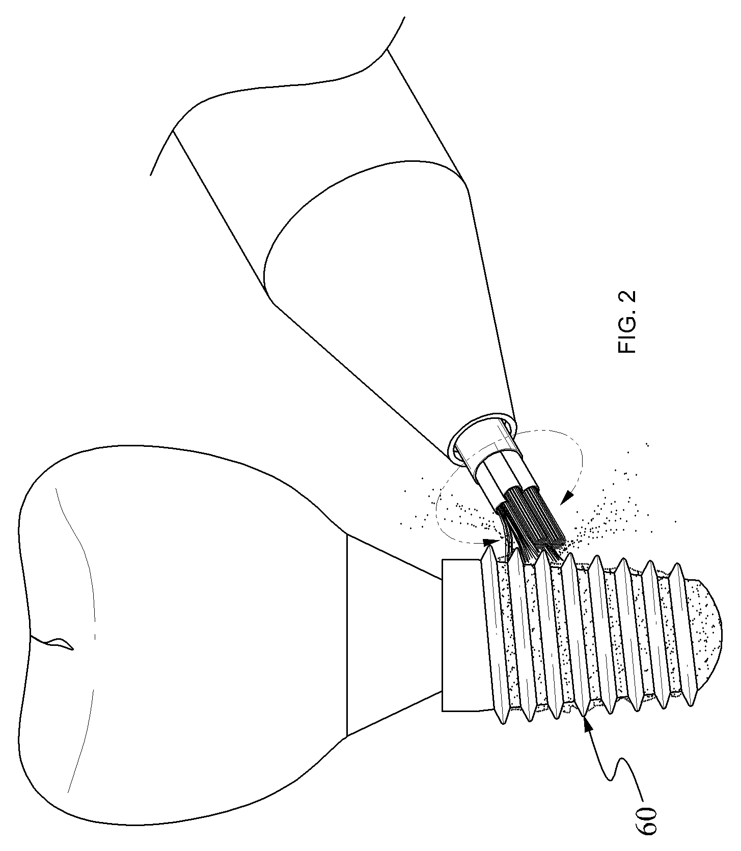 Infected dental implant cleaning technique