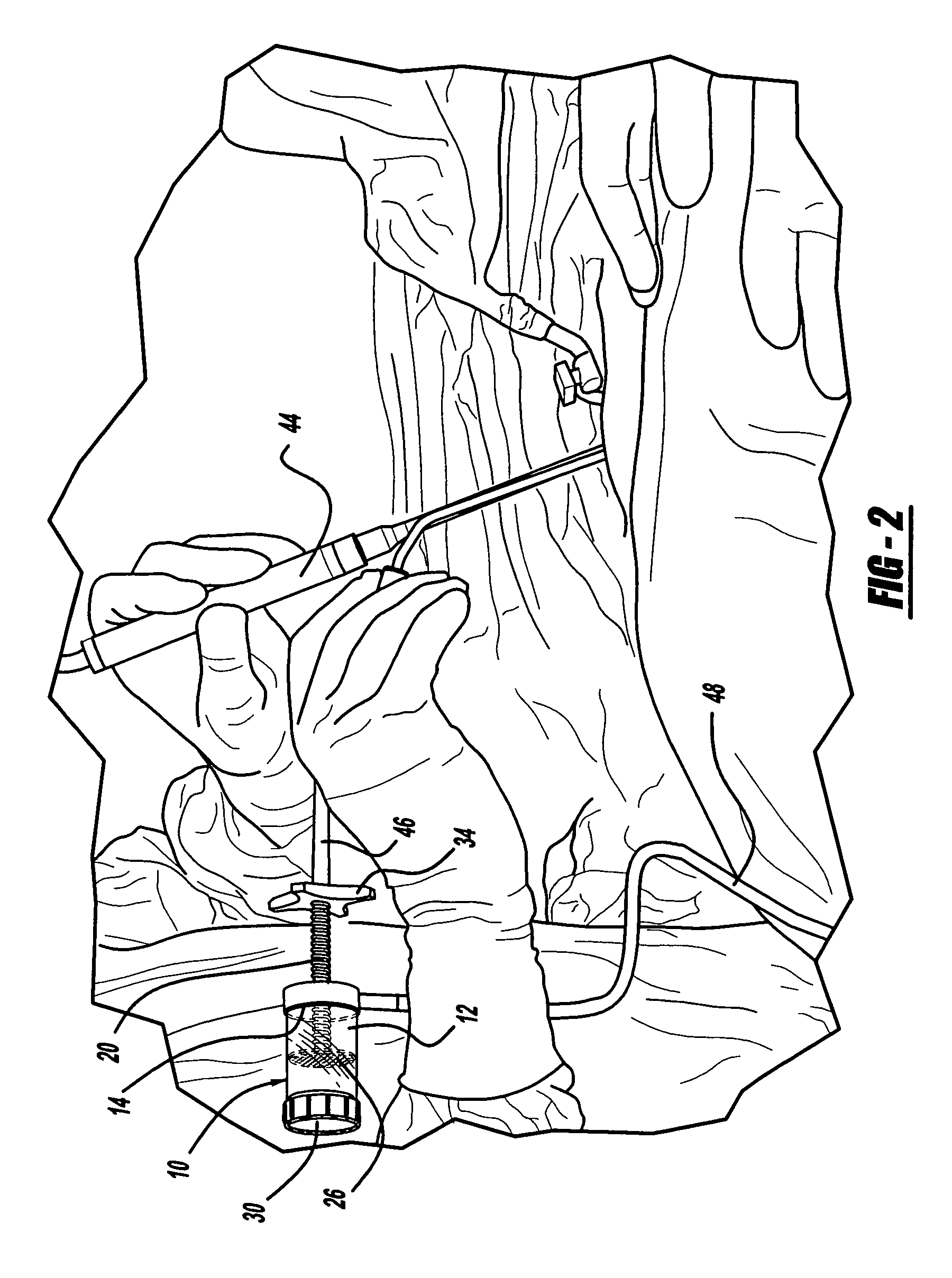 Device for collecting bone material during a surgical procedure