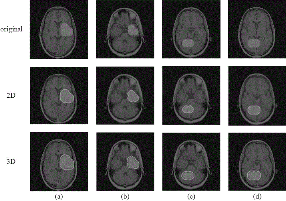 3D automatic glioma segmentation method combining Volume of Interest and GrowCut algorithm