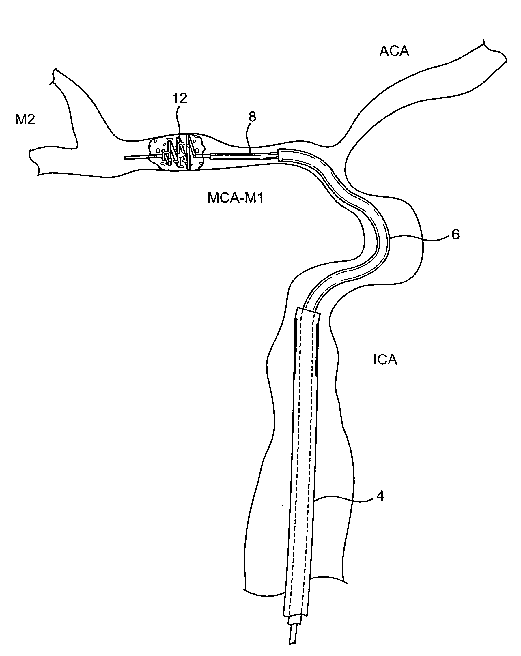 Devices and methods for removing obstructions from a cerebral vessel