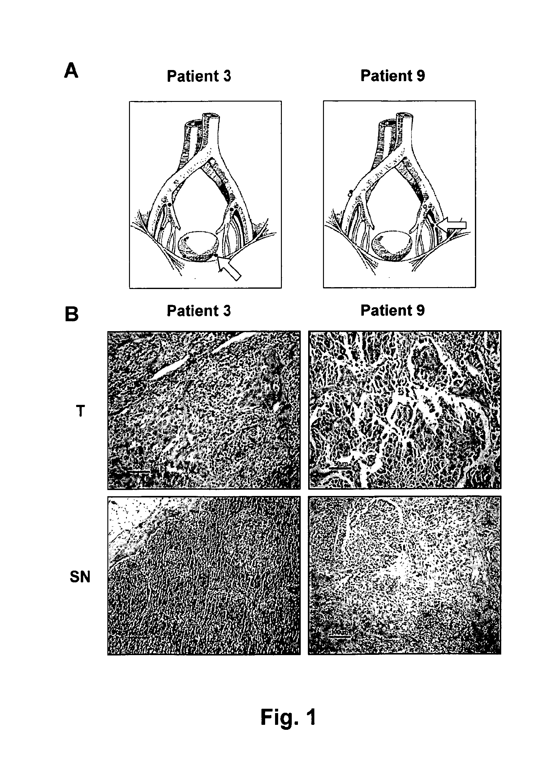 Method for Treating Urinary Bladder Cancer