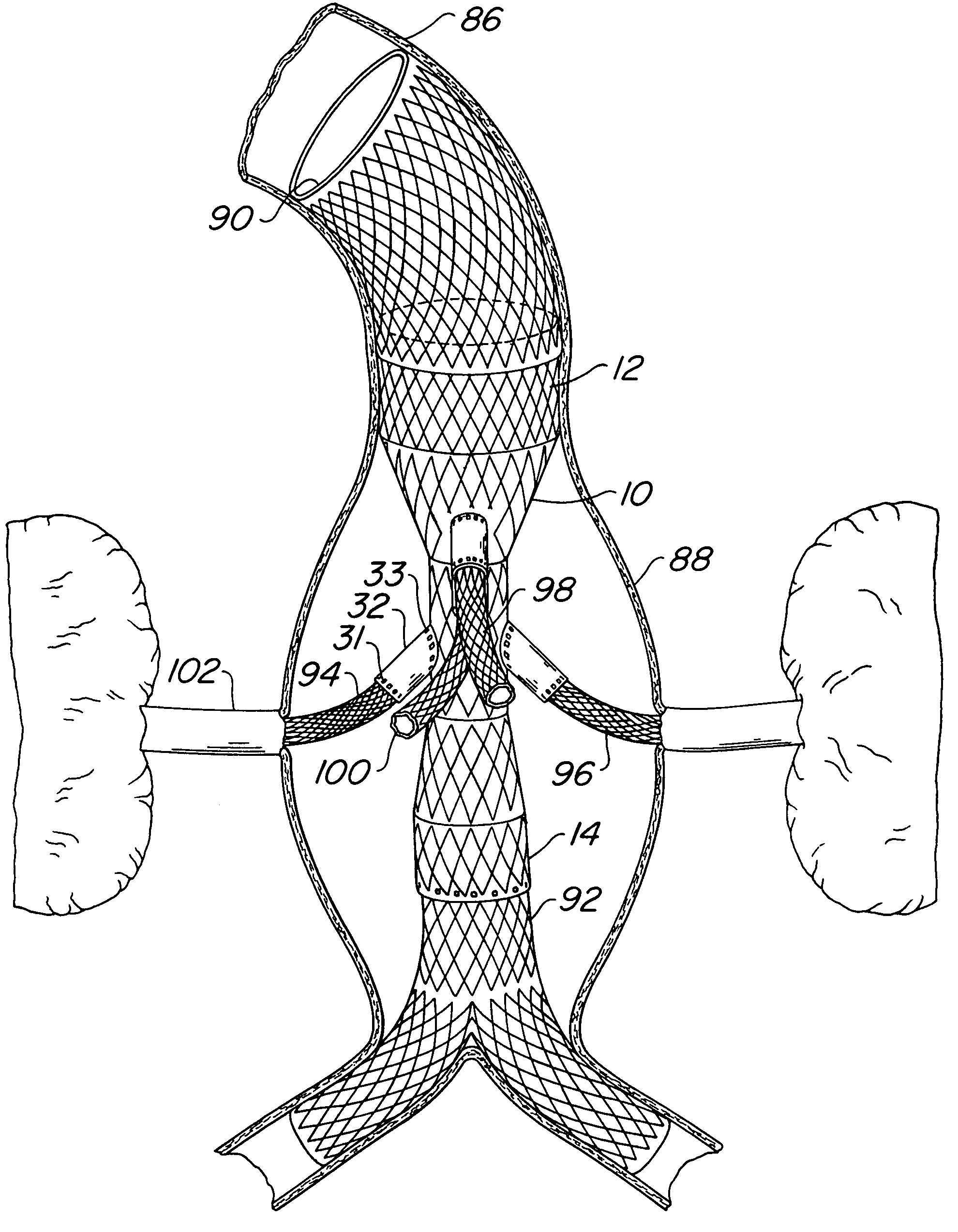 Endovascular prosthesis, system and method