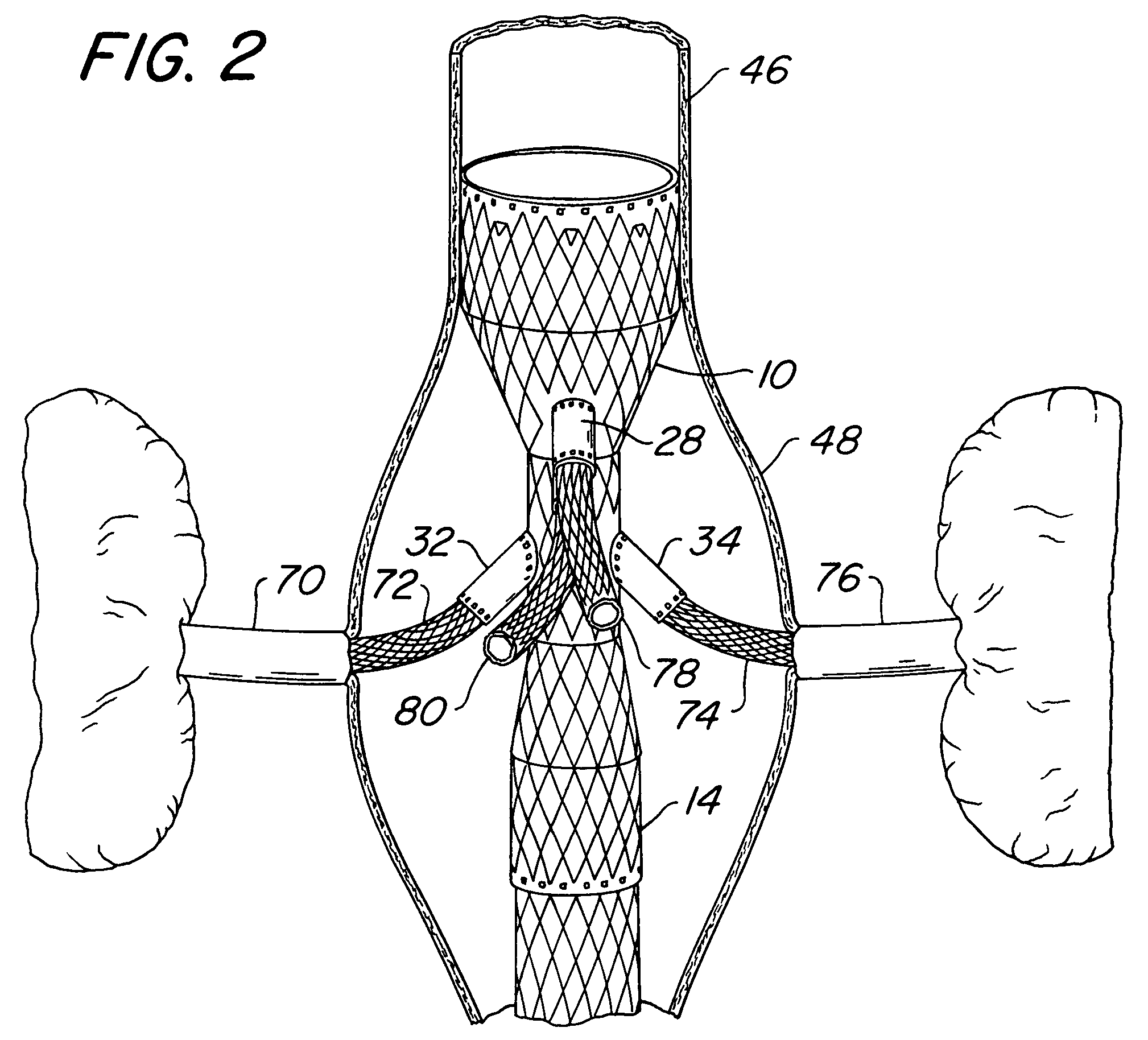 Endovascular prosthesis, system and method