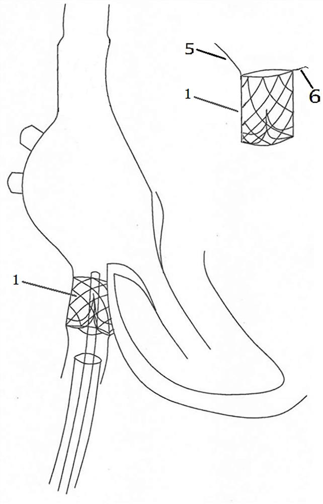 Combined self-expanding inferior vena cava stent